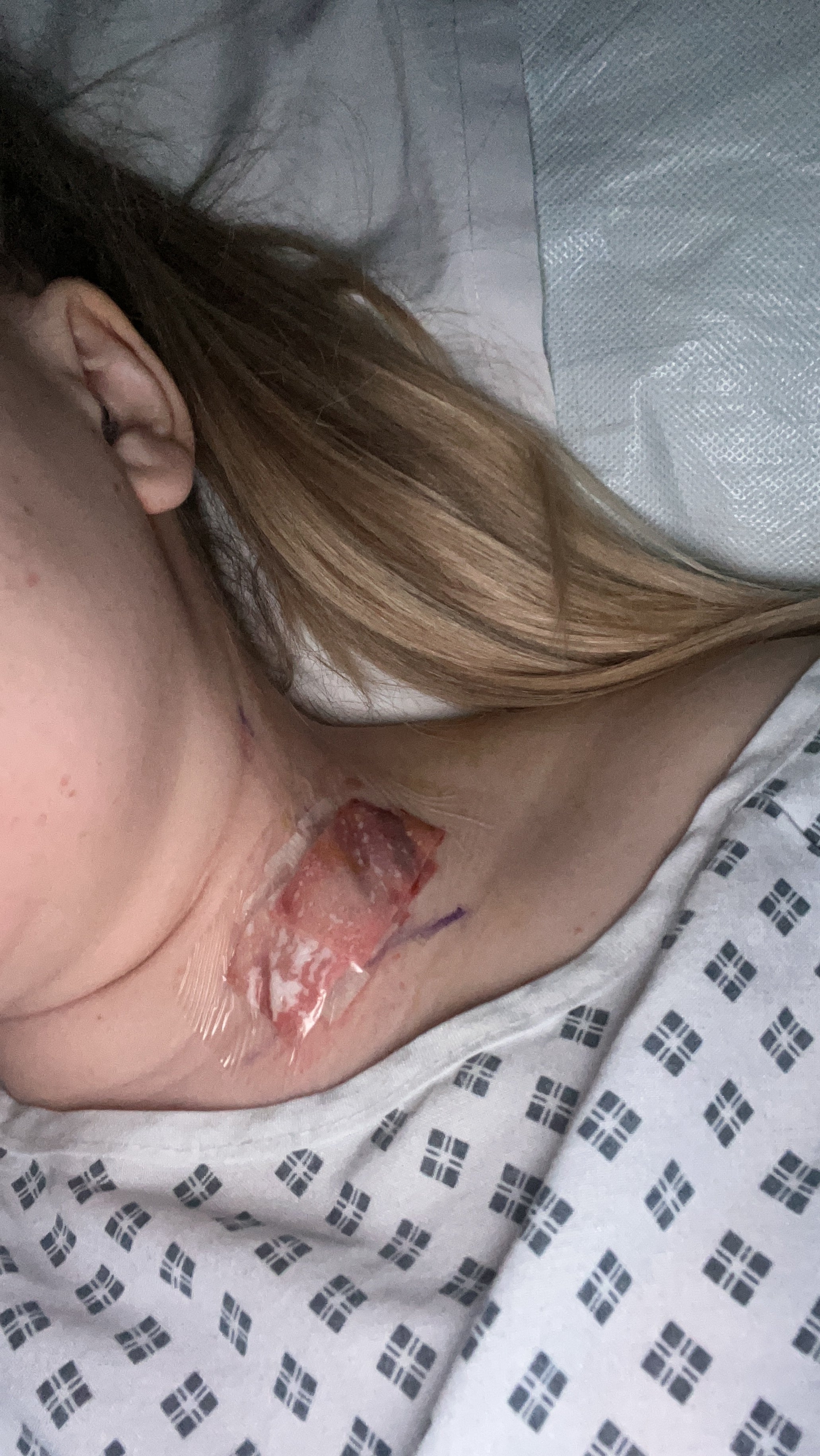 Lily in hospital with a scar