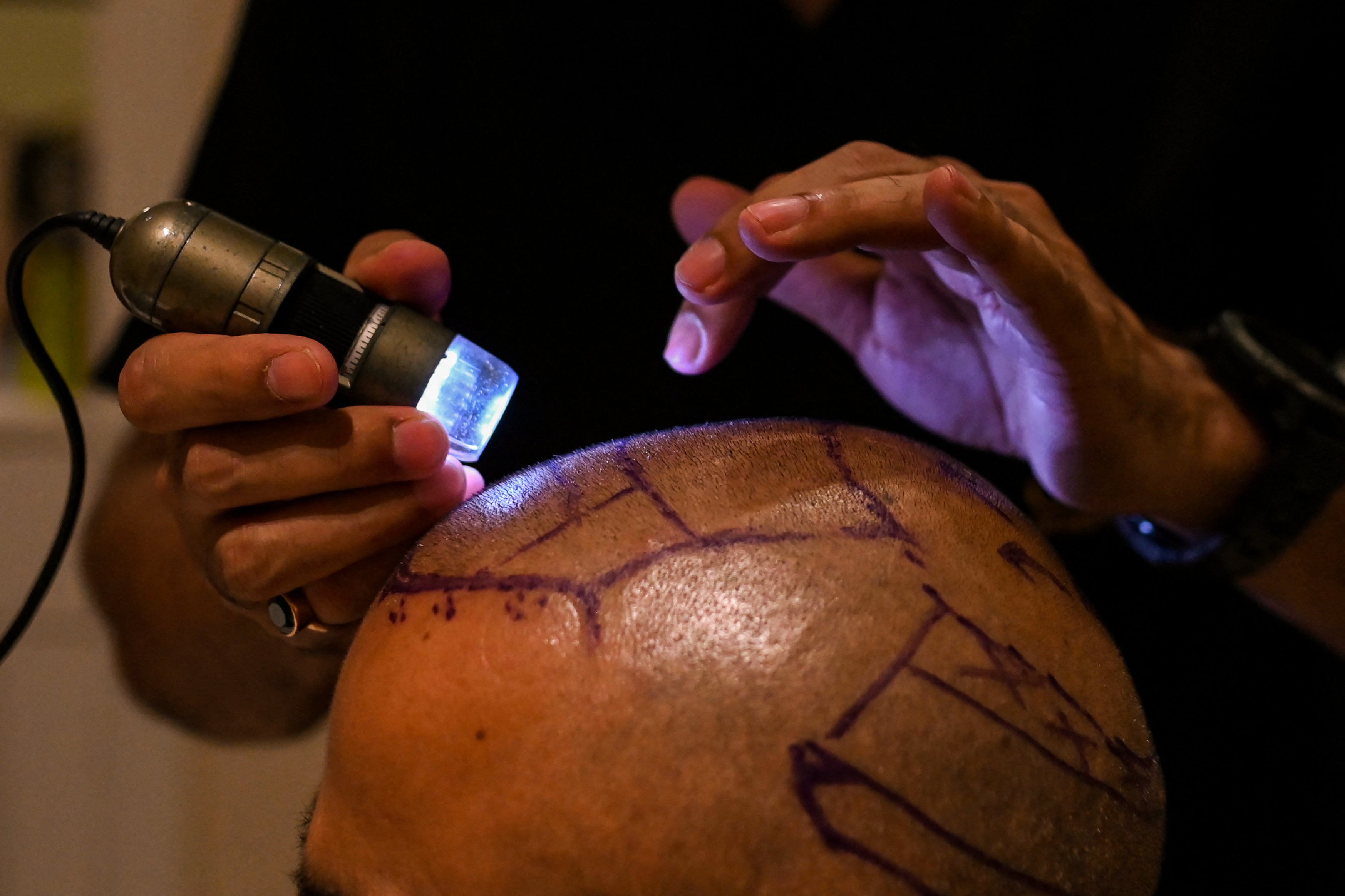 Two dead after hair transplant surgeries go horribly wrong