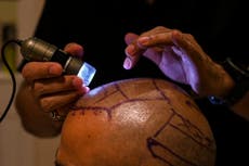 Two dead after hair transplant surgeries go horribly wrong