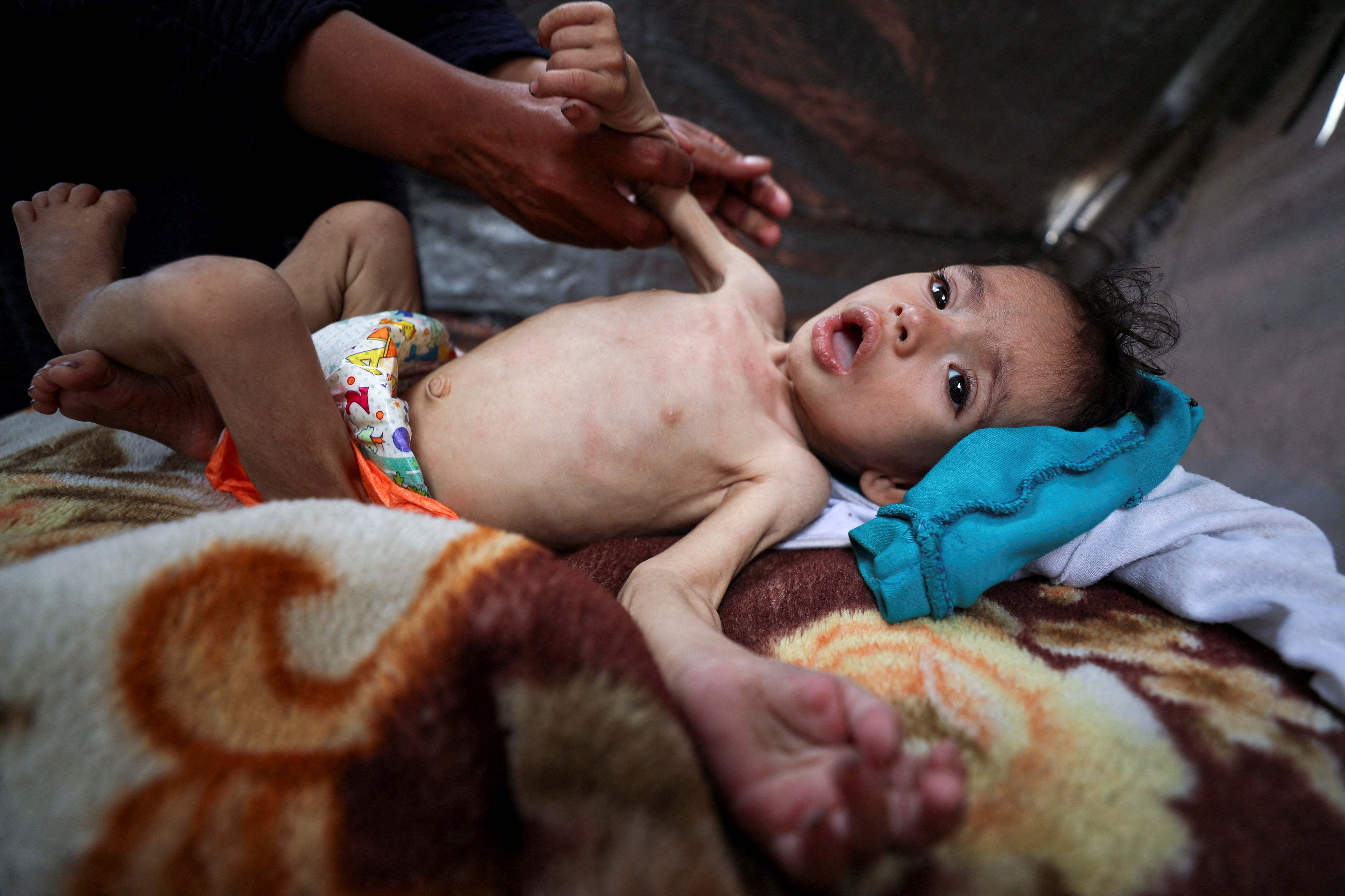 Zakaria, an underfed Palestinian boy, shelters in a tent after being displaced due to the Israeli military offensive