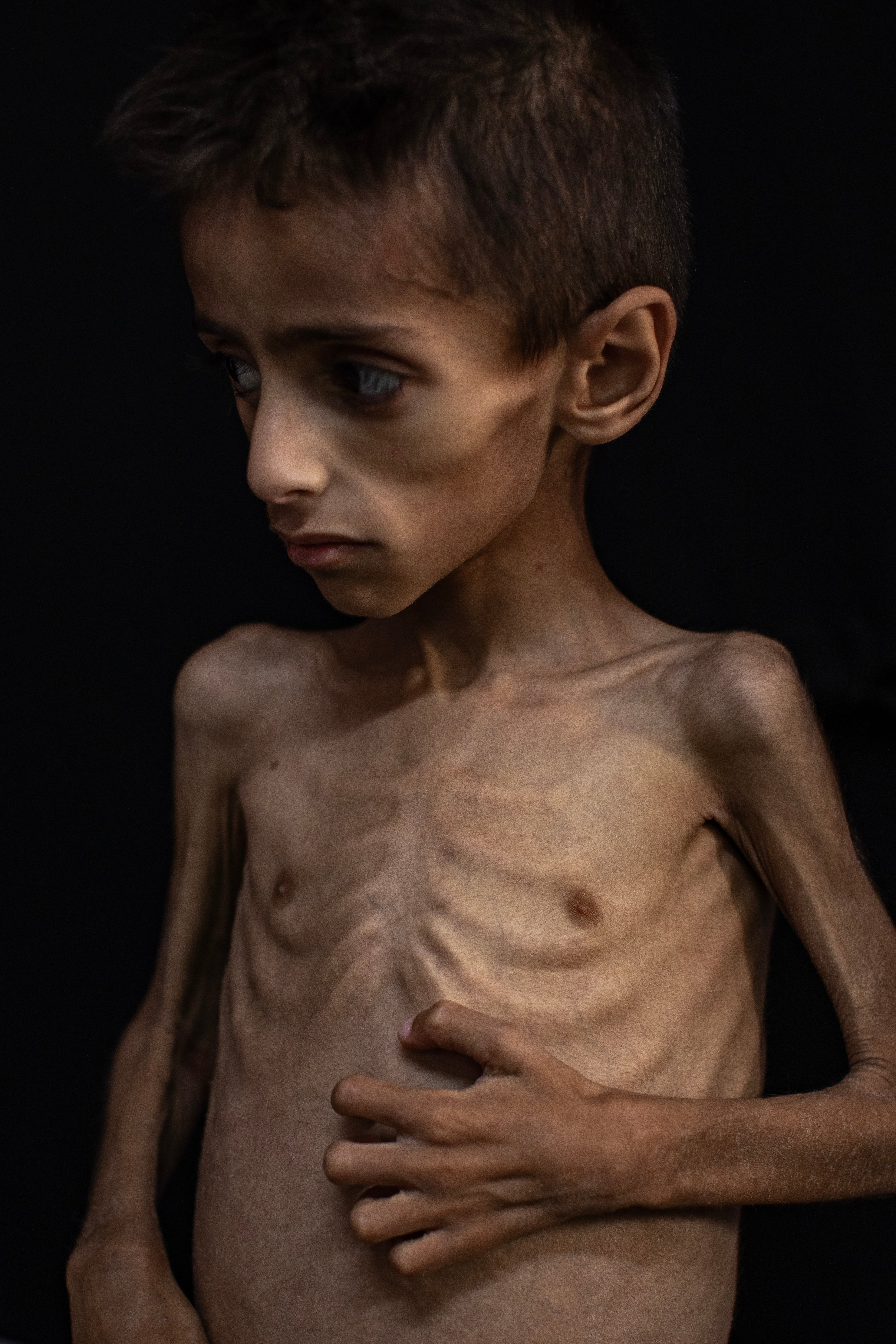 Five year-old Osama al-Raqab, suffering from severe malnutrition, undergoes treatment at the Nasser Hospital in Khan Youni in the southern Gaza Strip