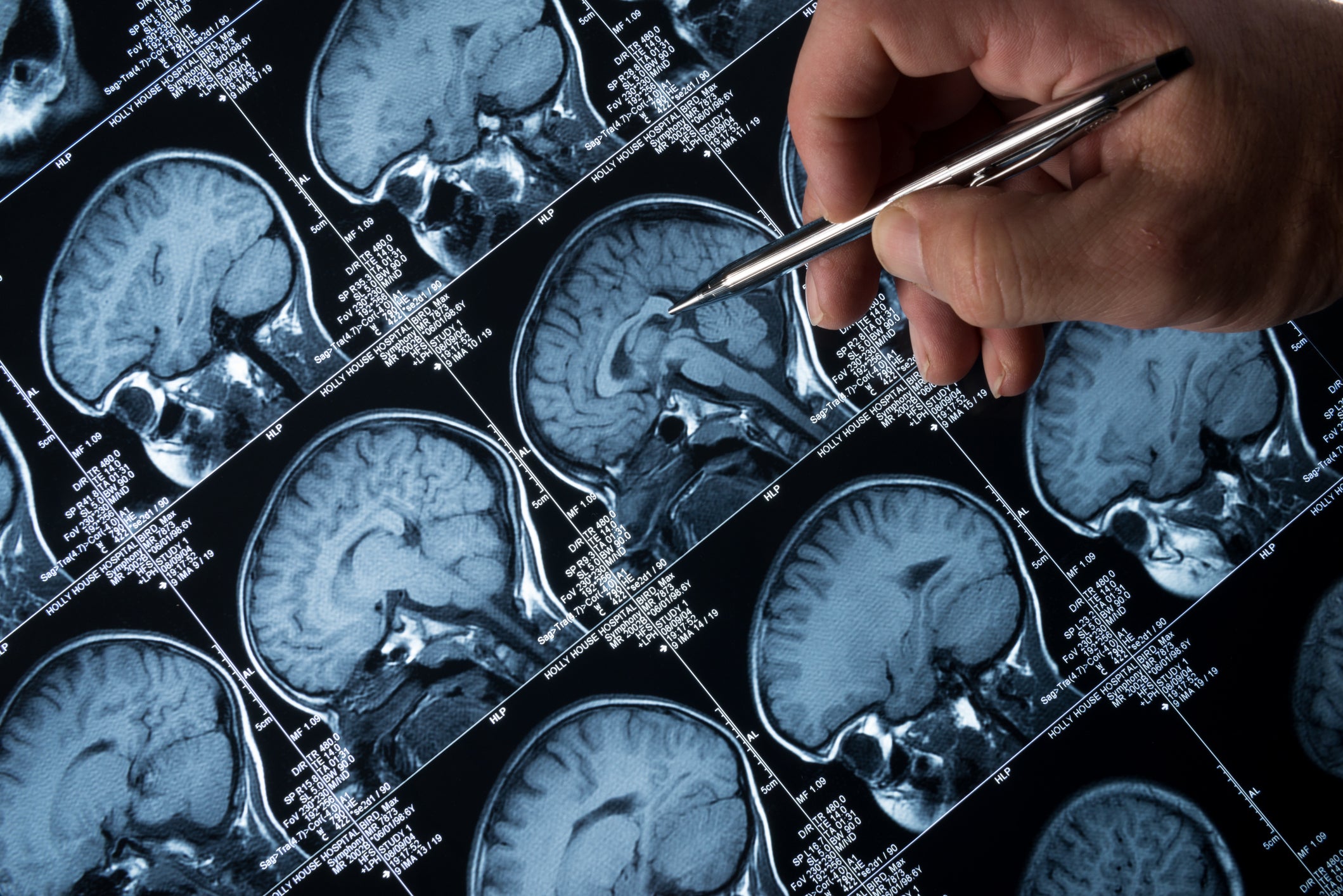 Research generally associates Alzheimer’s disease with the accumulation of toxic proteins that damager our brain cells