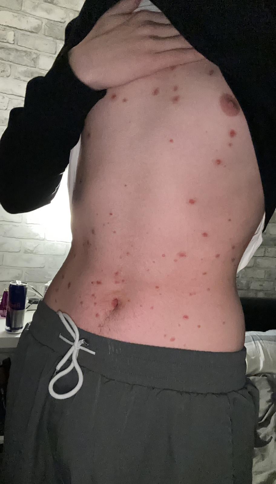 Charlie Michael Baker, 18, was diagnosed with psoriasis after an adverse reaction to dermal fillers
