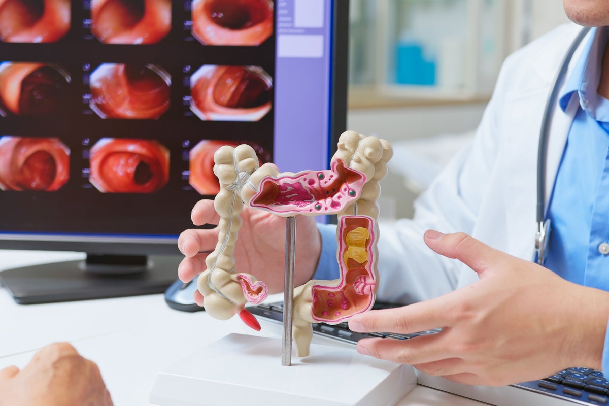 How a bowel cancer examination revealed AI’s negative impact on doctors How a bowel cancer examination revealed AI’s negative impact on doctors