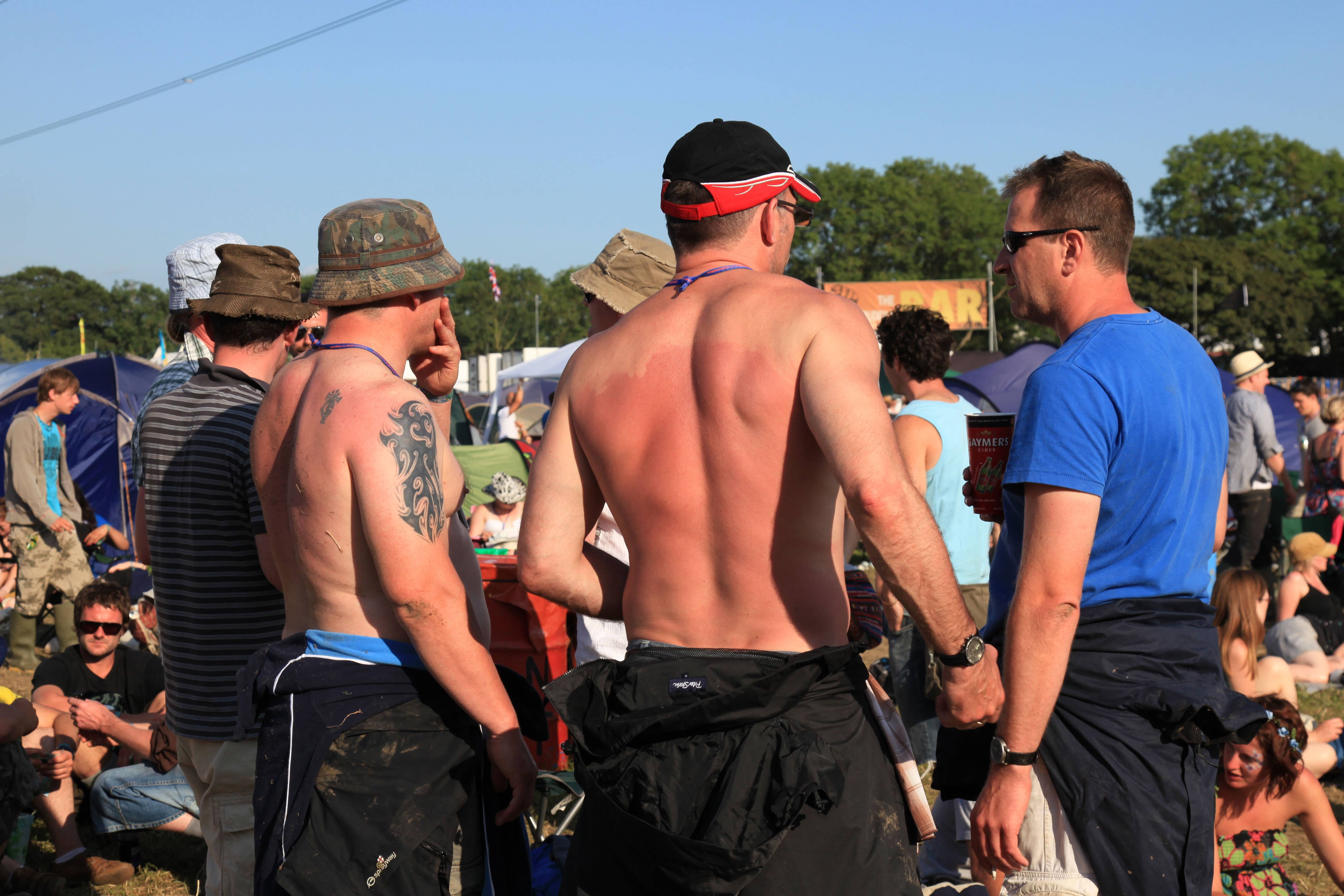 A minister has criticised the ‘obsession with laughing at people’ who get sunburn (Alamy/PA)