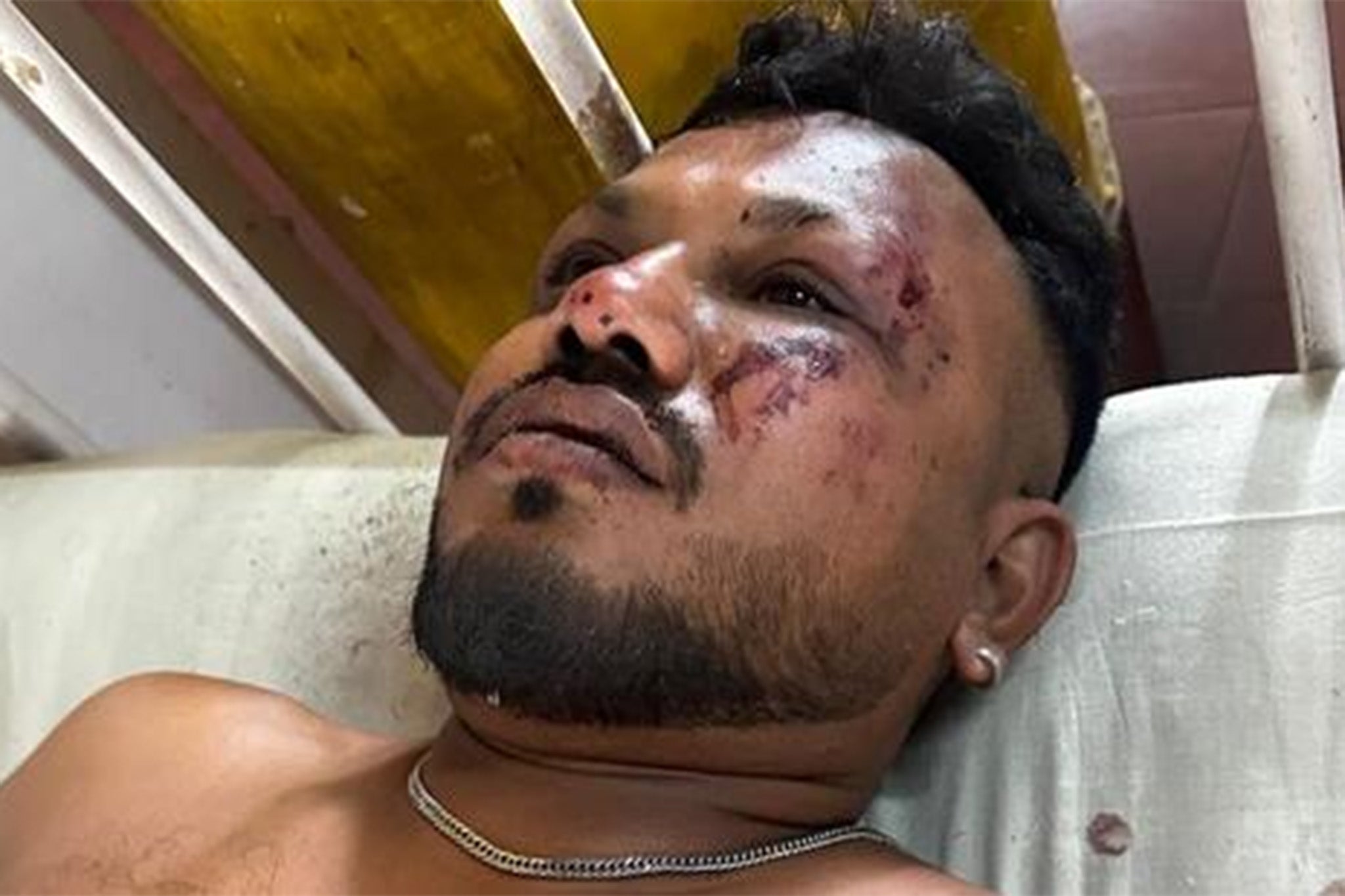 Vishwash Kumar Ramesh in hospital after escaping the Air India crash