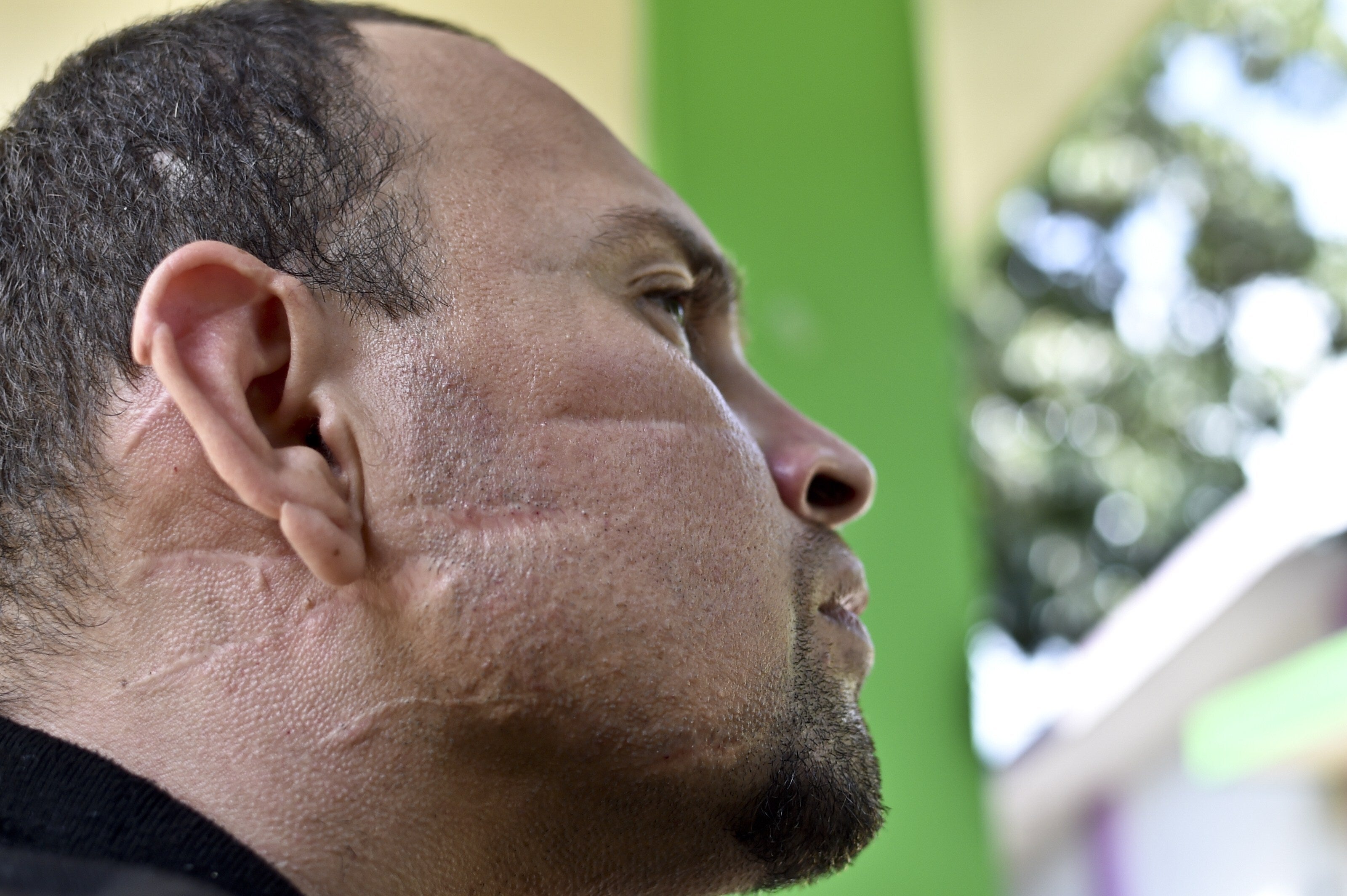 Central American migrant Jose Viera in Tapachula, Mexico, his face bearing some of the thirty-seven wounds sustained in a machete attack by gang members in El Salvador.