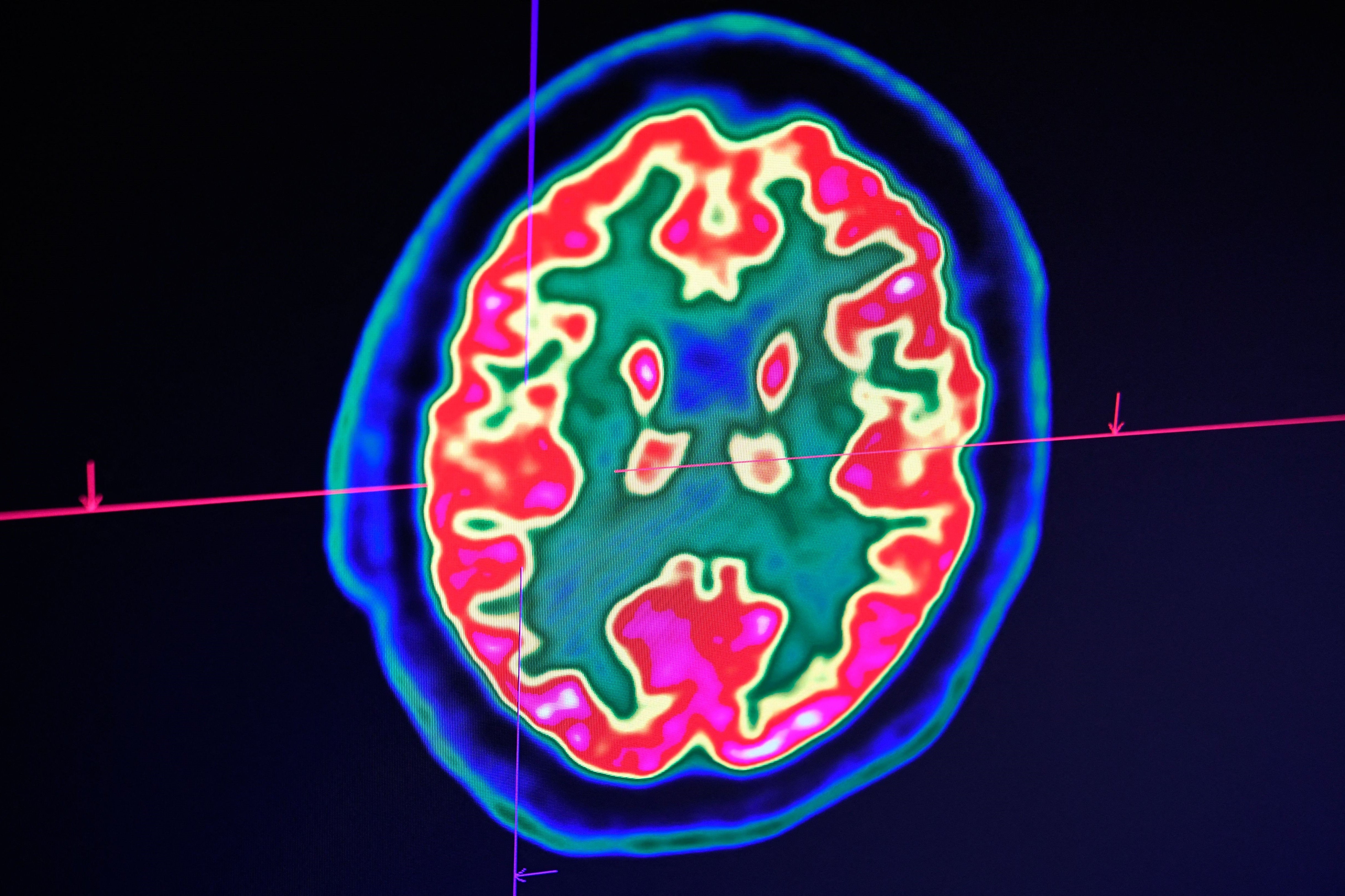 A picture of a human brain taken by a PET scan on 9 January, 2019, at the Regional and University Hospital Center of Brest