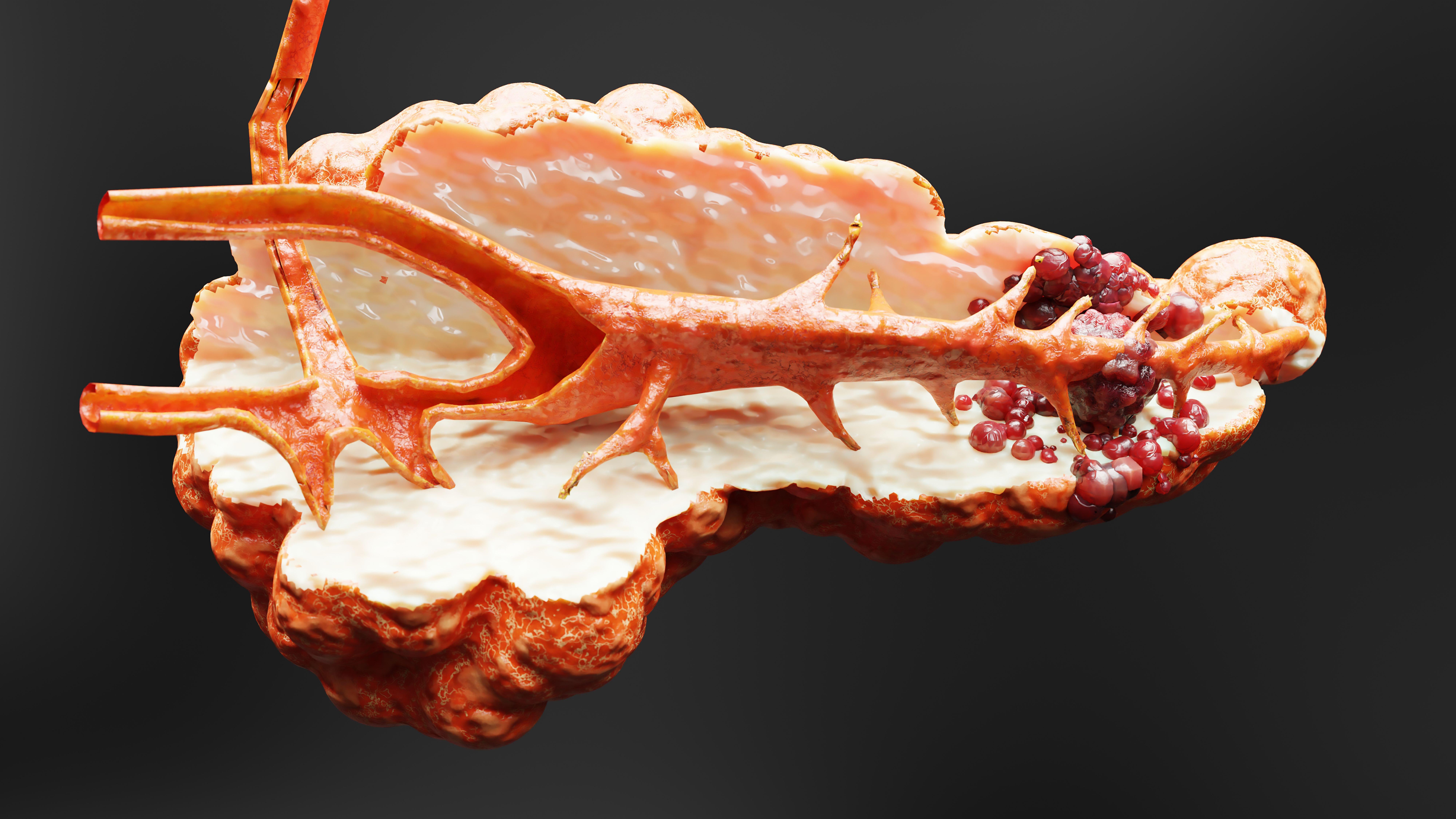 At the moment, pancreatic ductal adenocarcinoma (PDAC) often goes undetected until its advanced stages due to a lack of effective early diagnostic tools