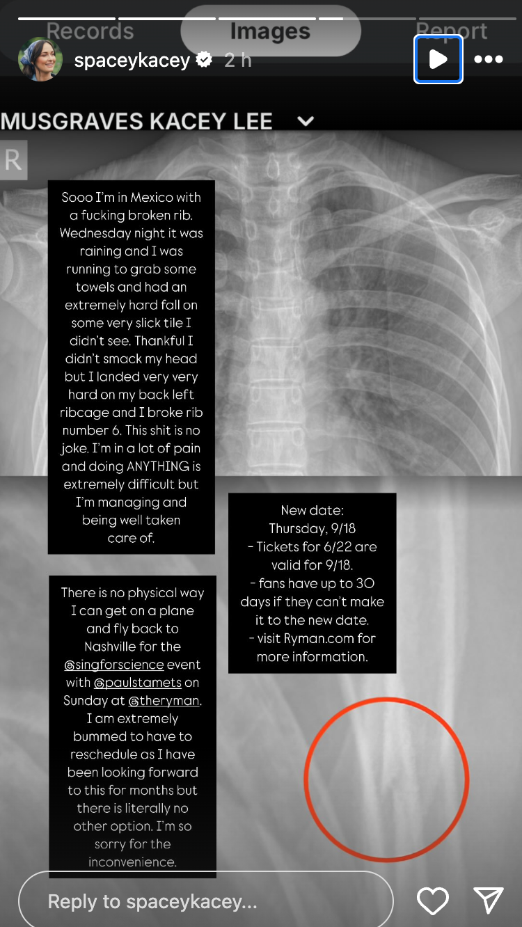 Kacey Musgraves suffered a broken rib after taking a nasty fall in Mexico