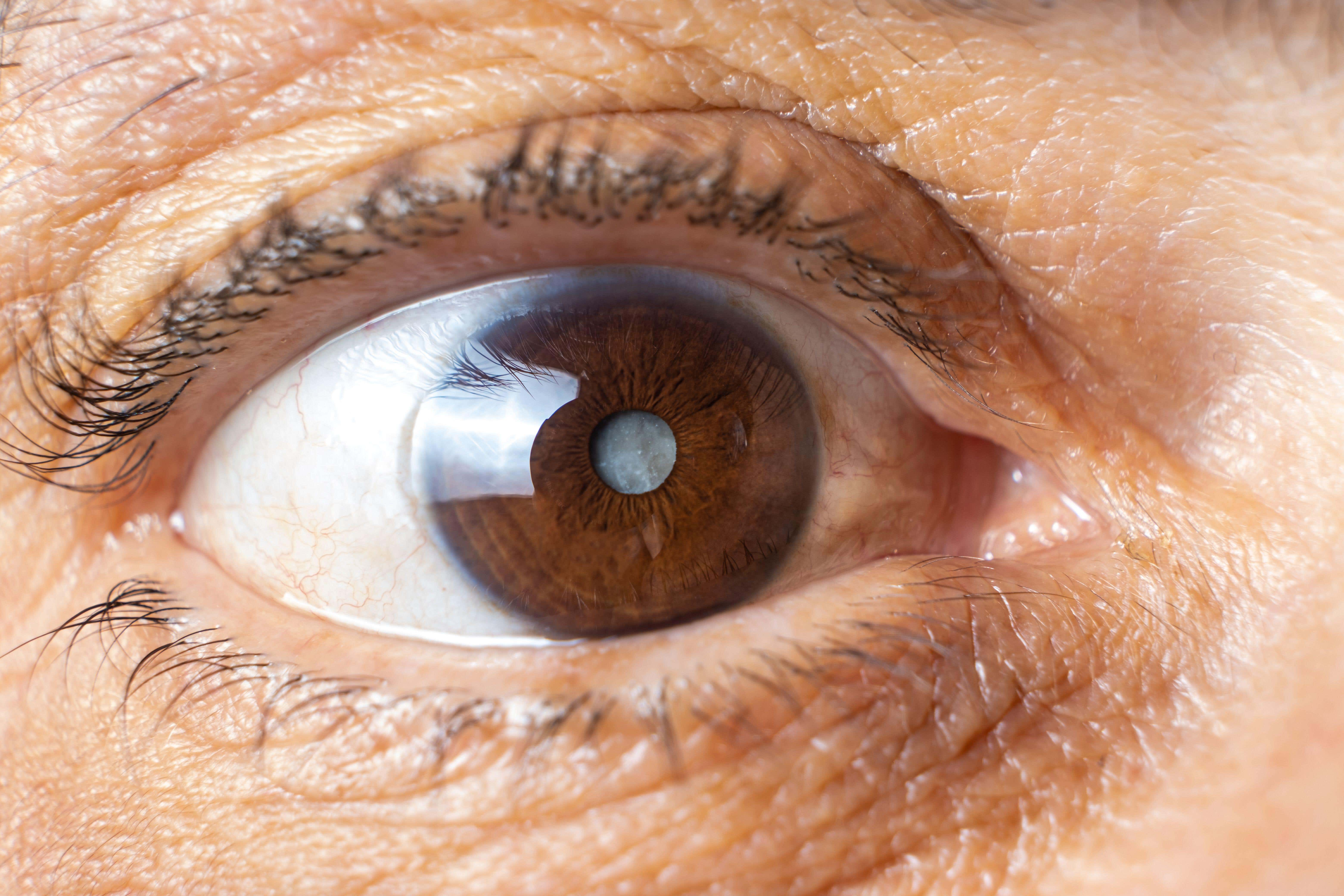 Getting older can increase your chance of developing many conditions, including pesky cataracts (Alamy/PA)