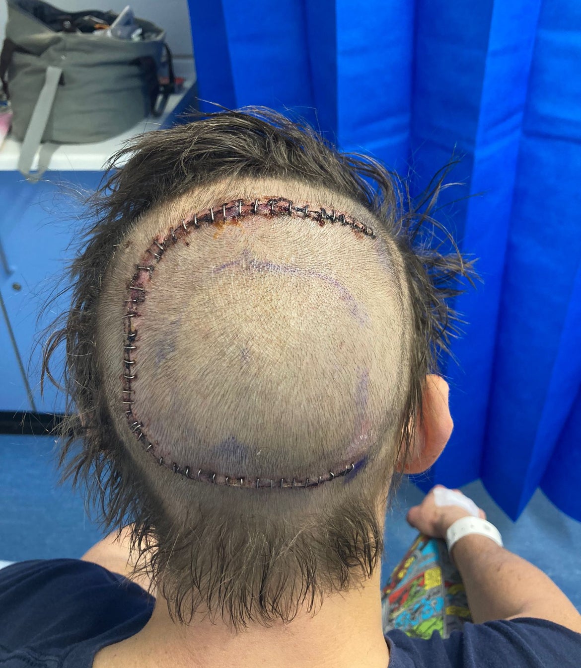 Craig had part of his skull removed during his operation in March 2023