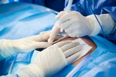 Researchers warn planned C-section births — the most common surgery in the US — can increase risk of childhood cancers