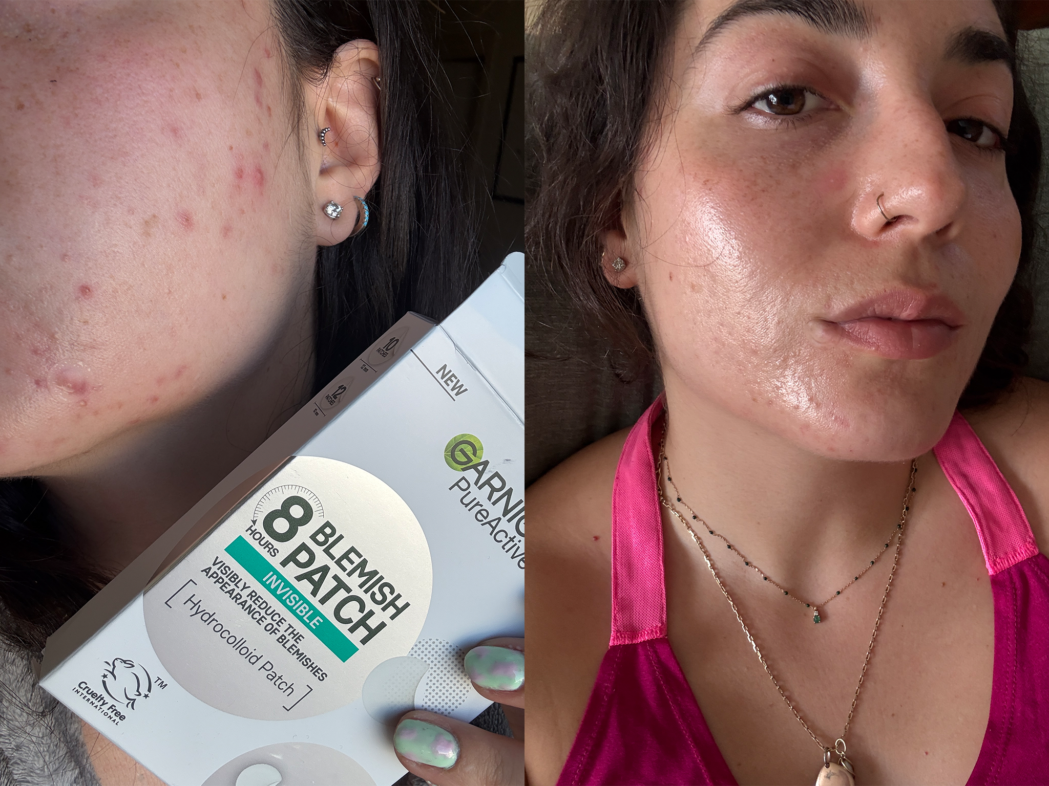 I wore patches from Starface, Garnier and more