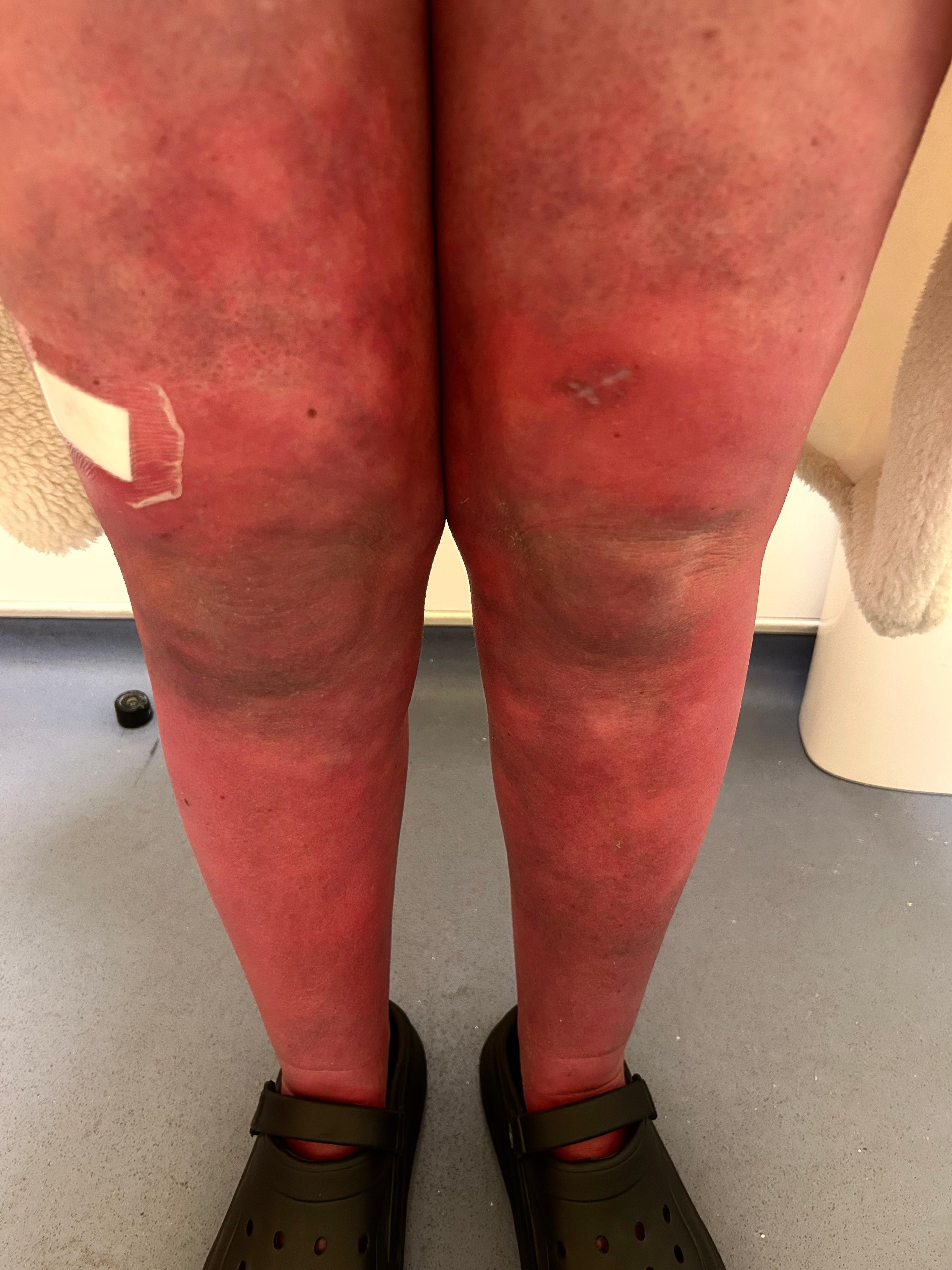 Ms Bradford has been diagnosed with erythromelalgia