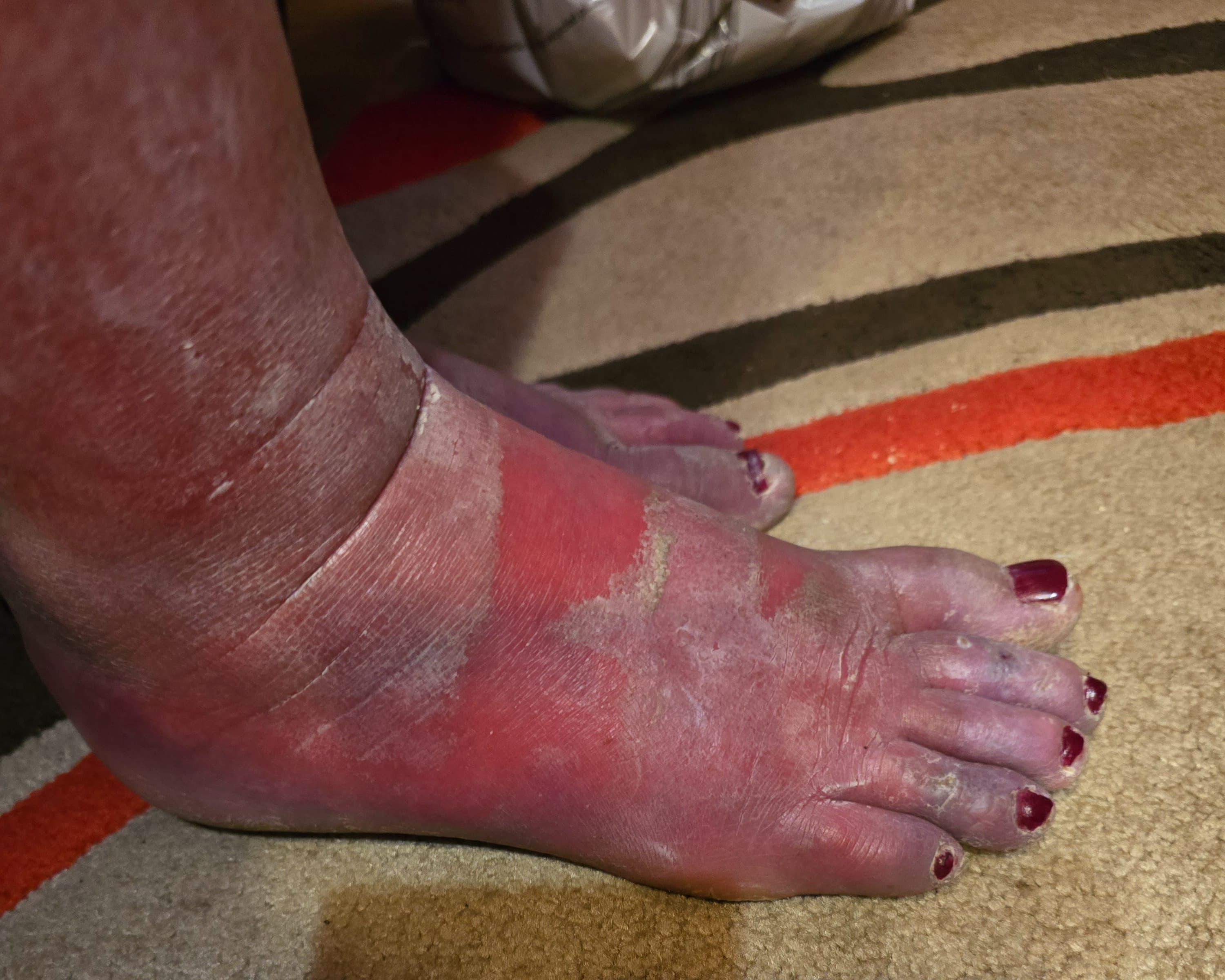 Rachel struggles with her mobility and her independence