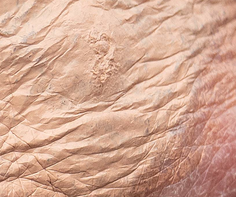 One part of Trump's hand appeared to have a raised scar in July