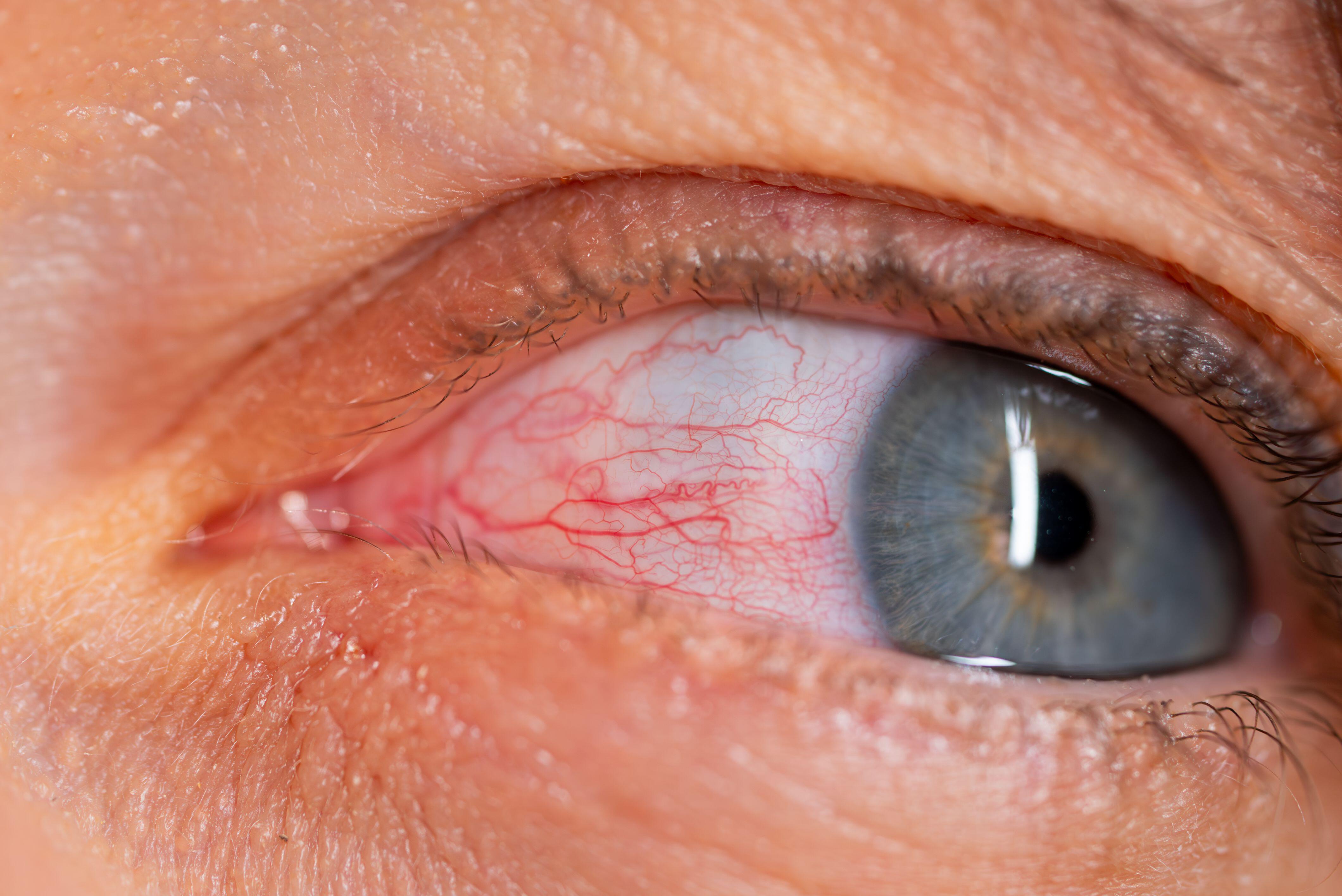 O bimatoprost pode causar queima, garganta, seca e irritação nos olhos