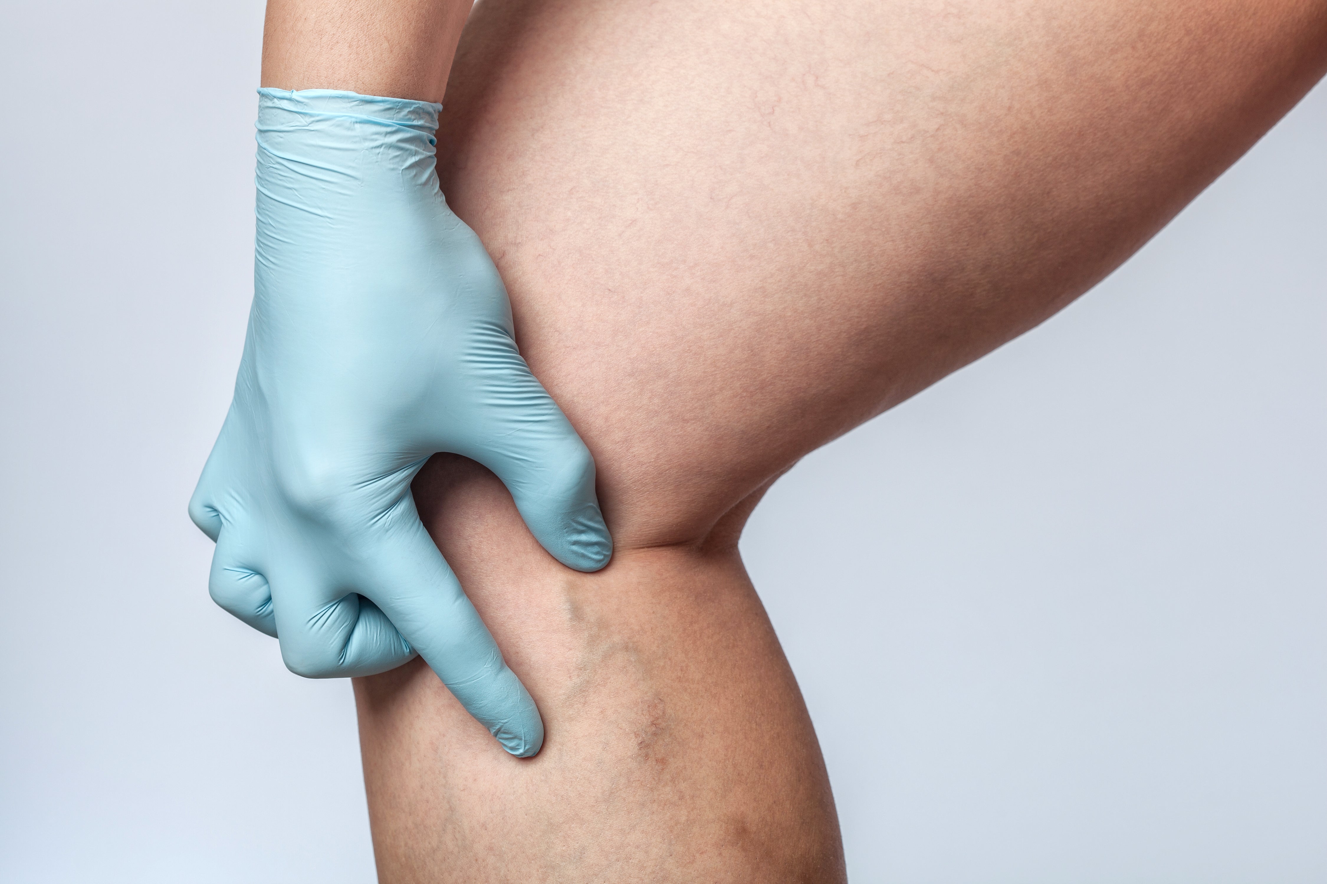 If left untreated, chronic venus insufficiency may result in varicose veins, leg ulcers, and other symptoms. The condition is common in people over the age of 70 years old