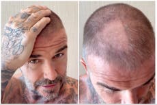 David Beckham left with bald patch after ‘terrible’ hair accident
