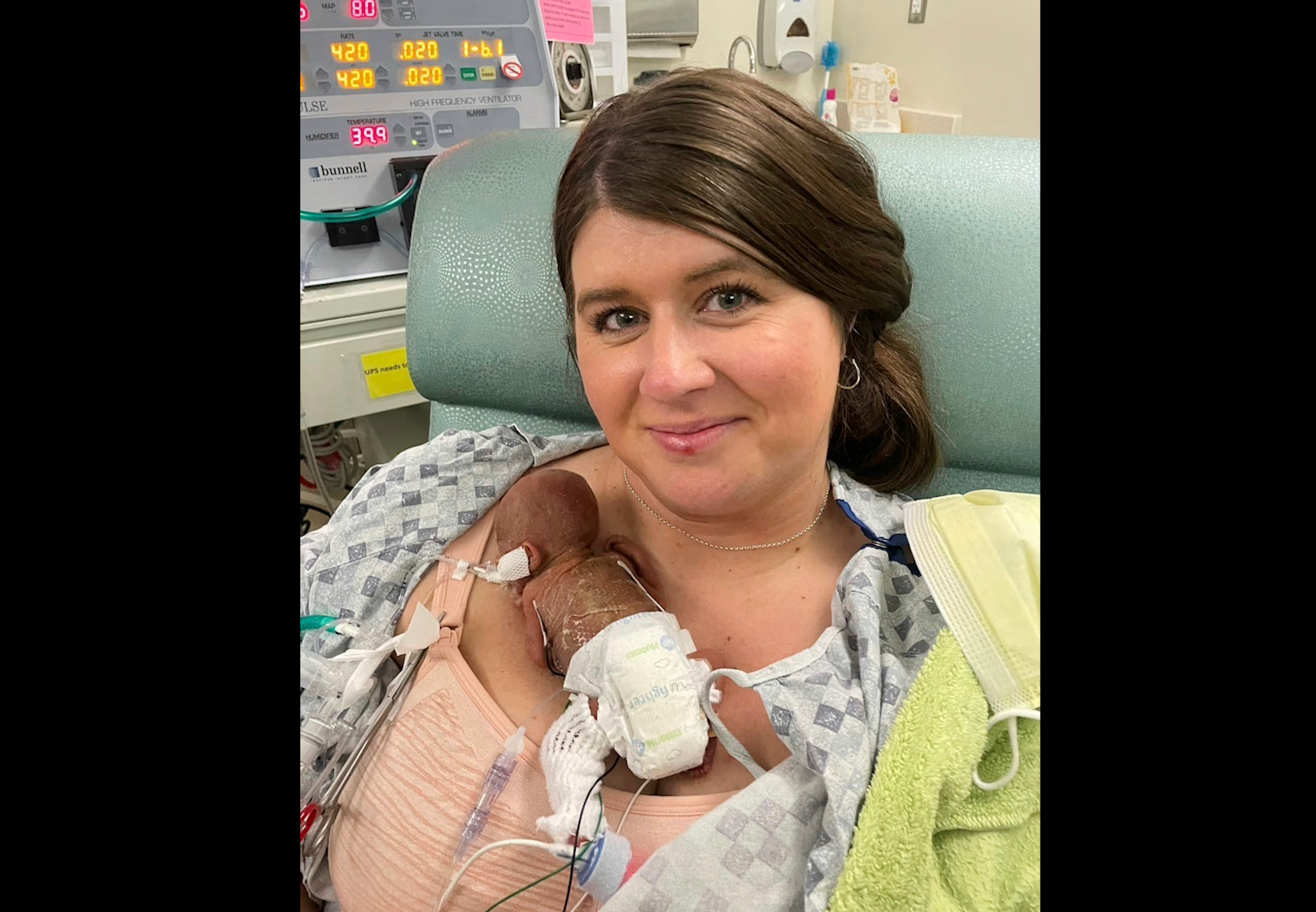 After becoming pregnant with Nash, the Keens learned at Mollie’s 20-week prenatal checkup that she was already two centimeters dilated. Doctors don't typically try to perform lifesaving measures for babies born before 22 weeks gestation as most born that young can't survive