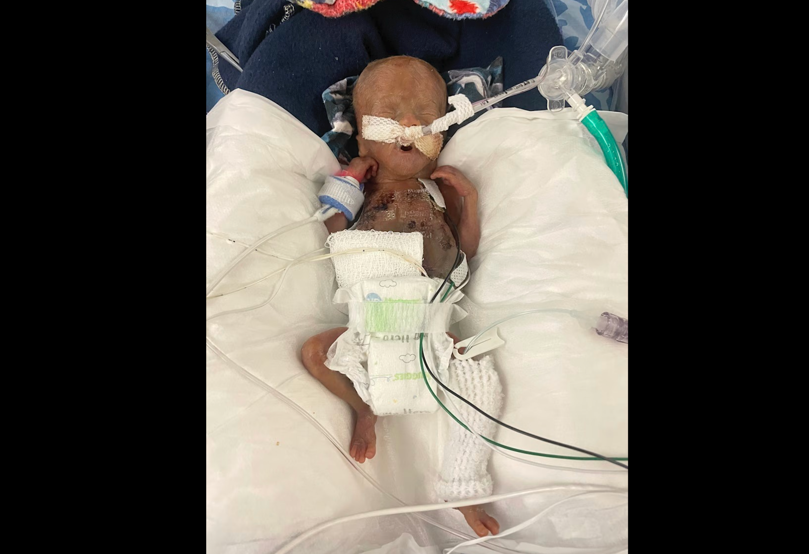 A little boy born at only 21 weeks of gestation has officially broken the record for the world’s most premature baby. Nash Keen was born in Iowa City, Iowa, on July 5, 2024 — 133 days earlier than the expected due date and weighing only 10 ounces