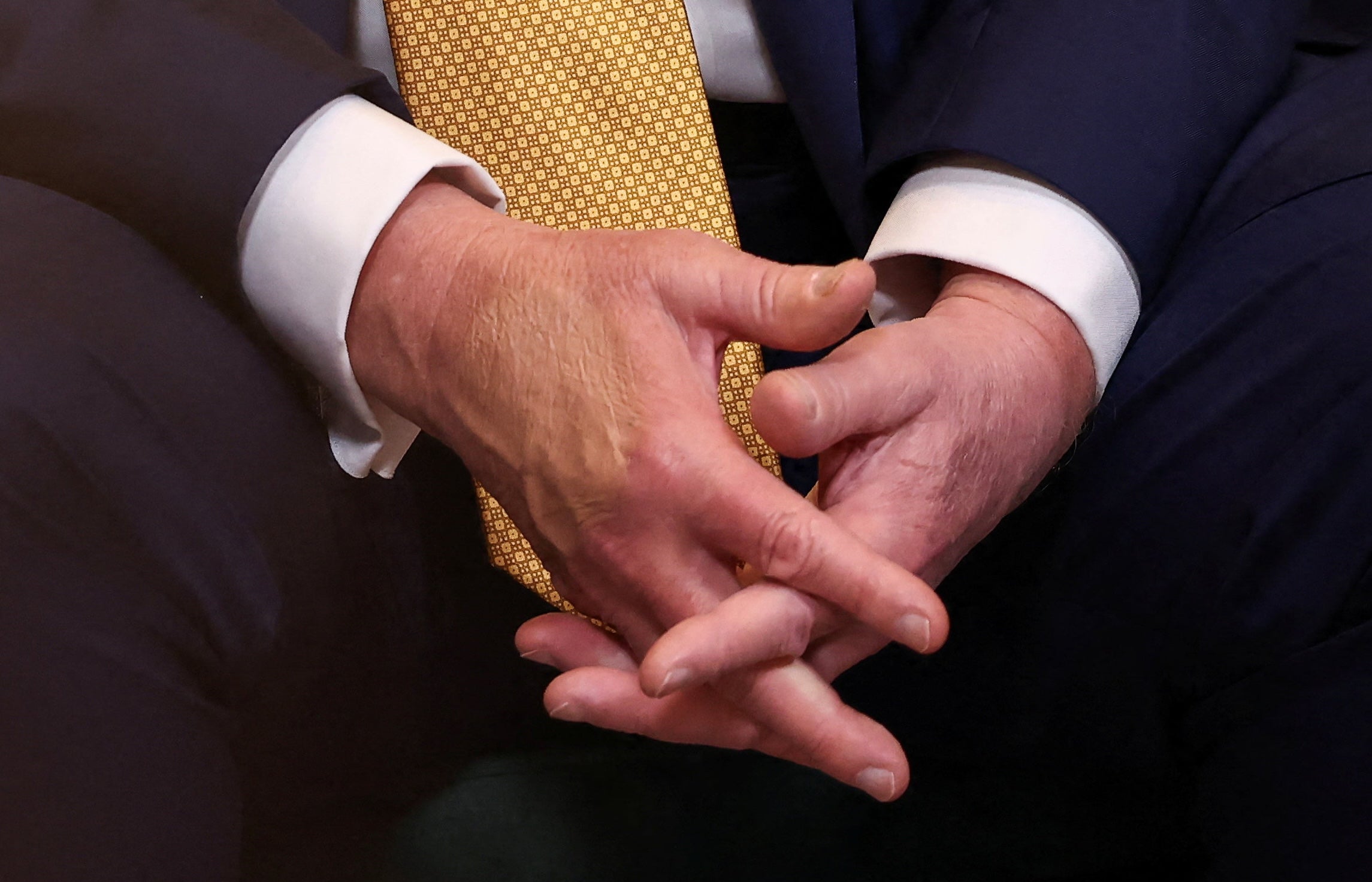 President Donald Trump covers up bruising on the back of his right hand with concealer. The White House attributes the bruising to the large number of handshakes the president receives.