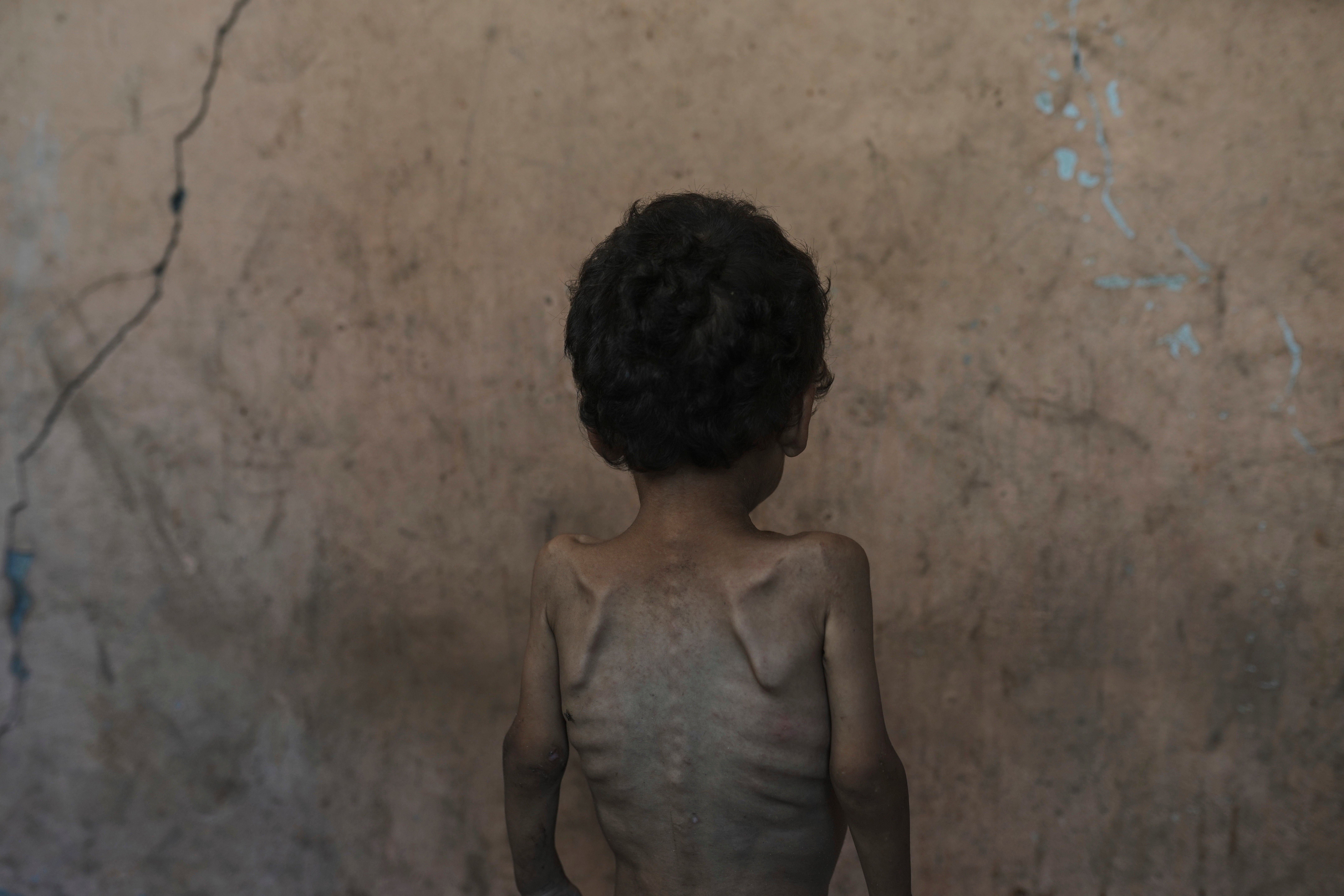 Yazan Abu Ful, a malnourished Gazan two-year-old
