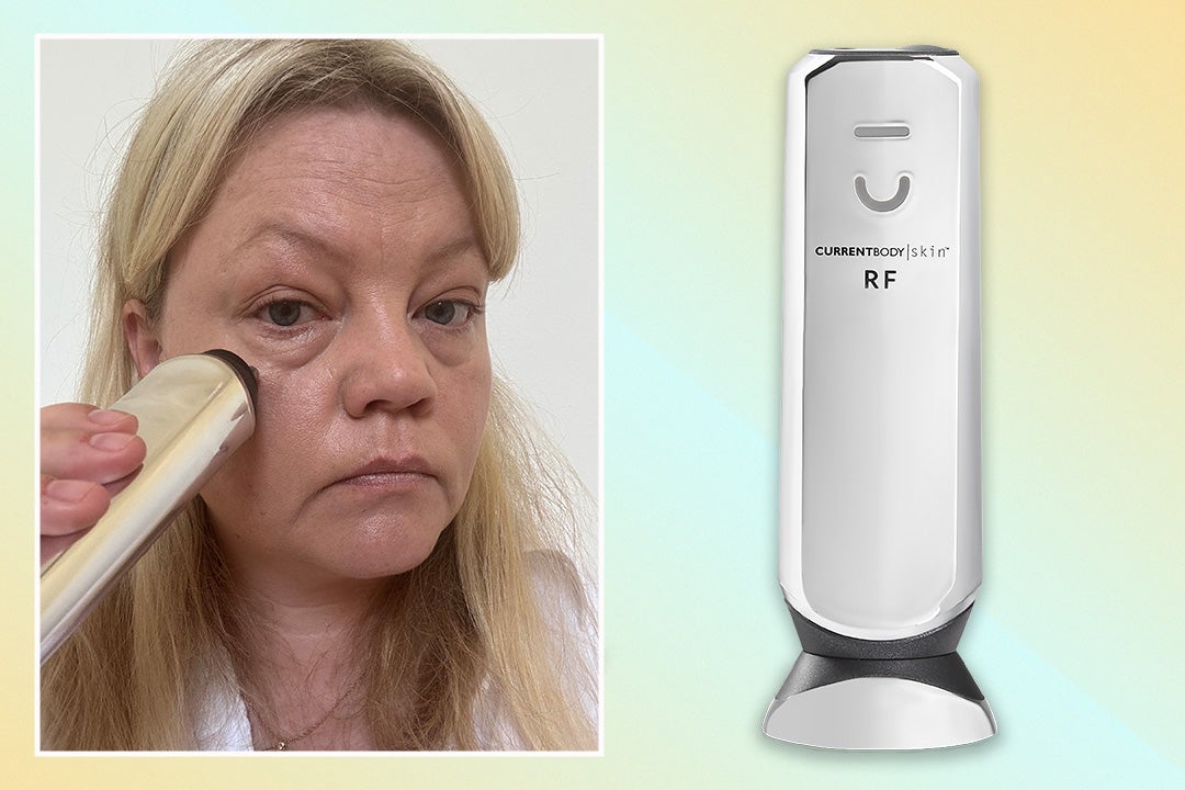 <p>The treatment combines microneedling and radiofrequency therapy</p>