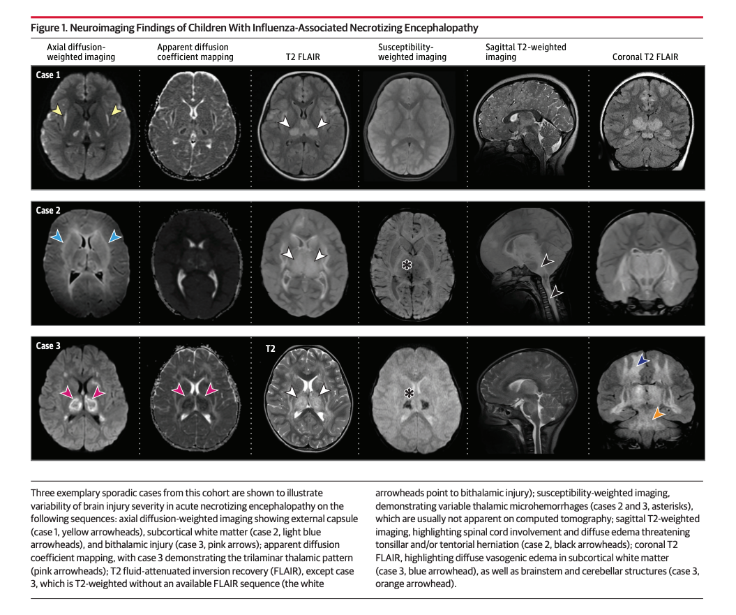 Brain scans shows children who have flu-linked cases of acute necrotizing encephalopathy. Doctors have identified 41 cases over the past two flu seasons