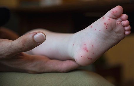 Hand, foot, and mouth disease is surging across eastern states, according to doctors. But, why remains unclear