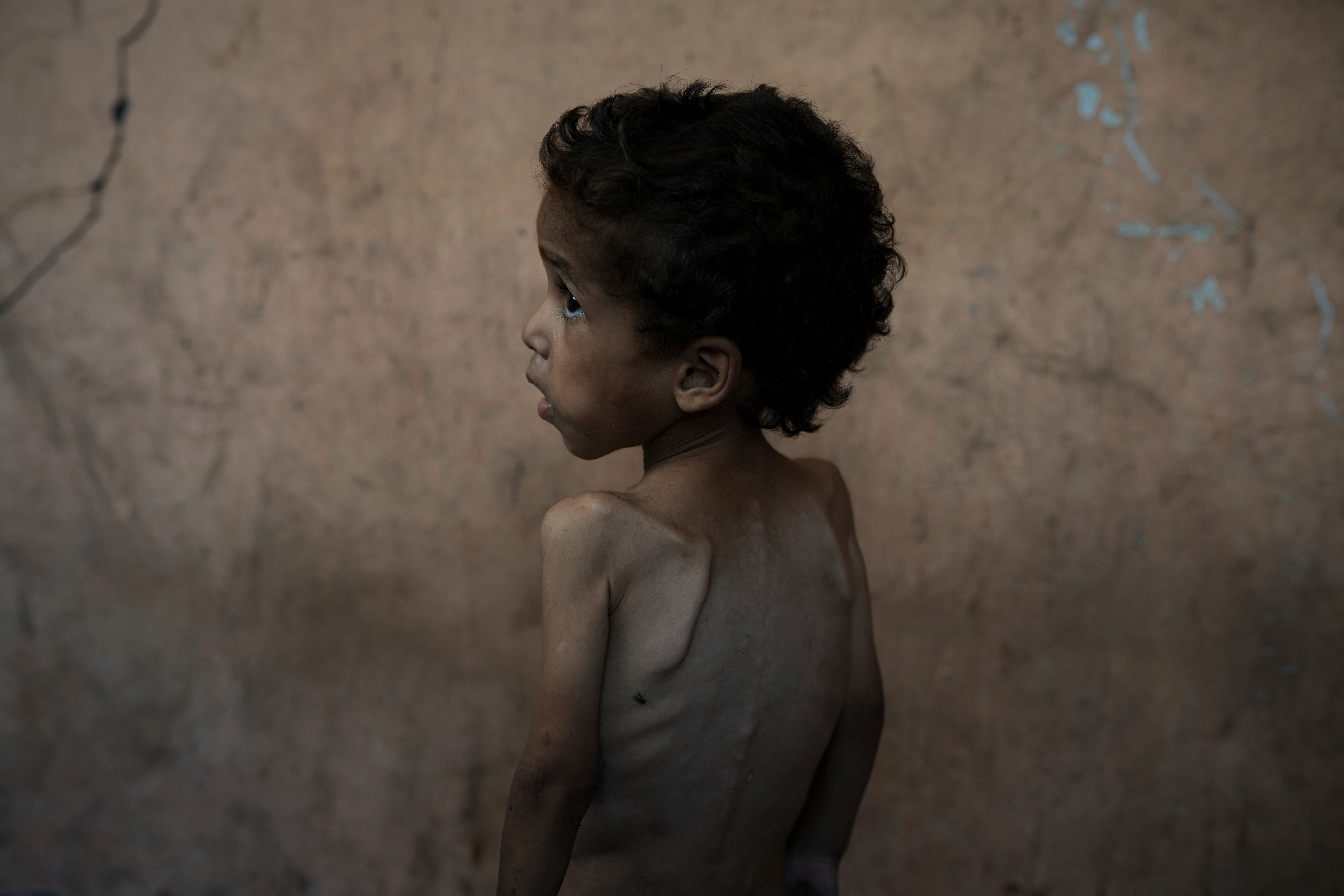 Mideast Wars Gaza Starvation Photo Essay