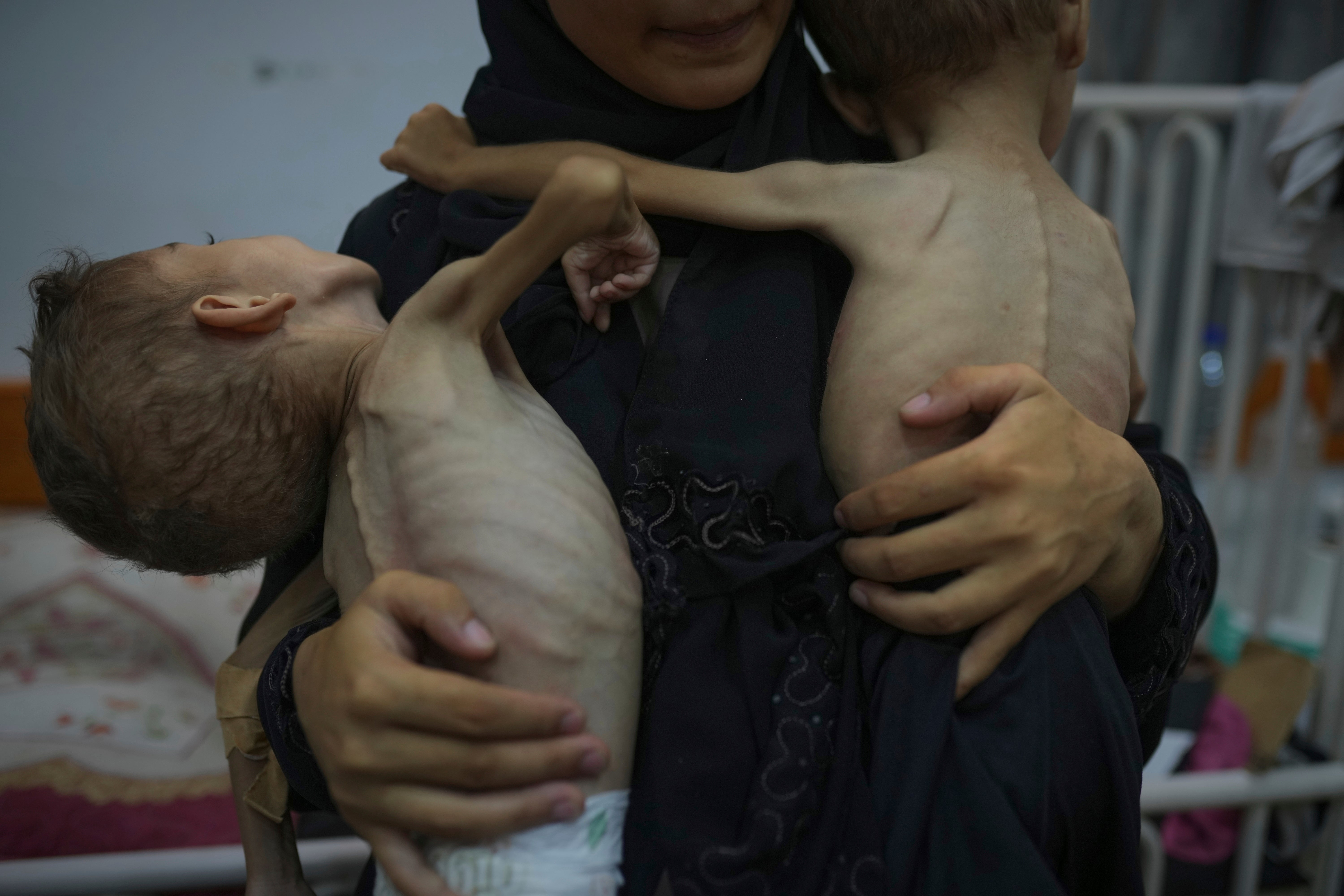 Malnutrition remains a major concern in Gaza, with thousands of children being hospitalized