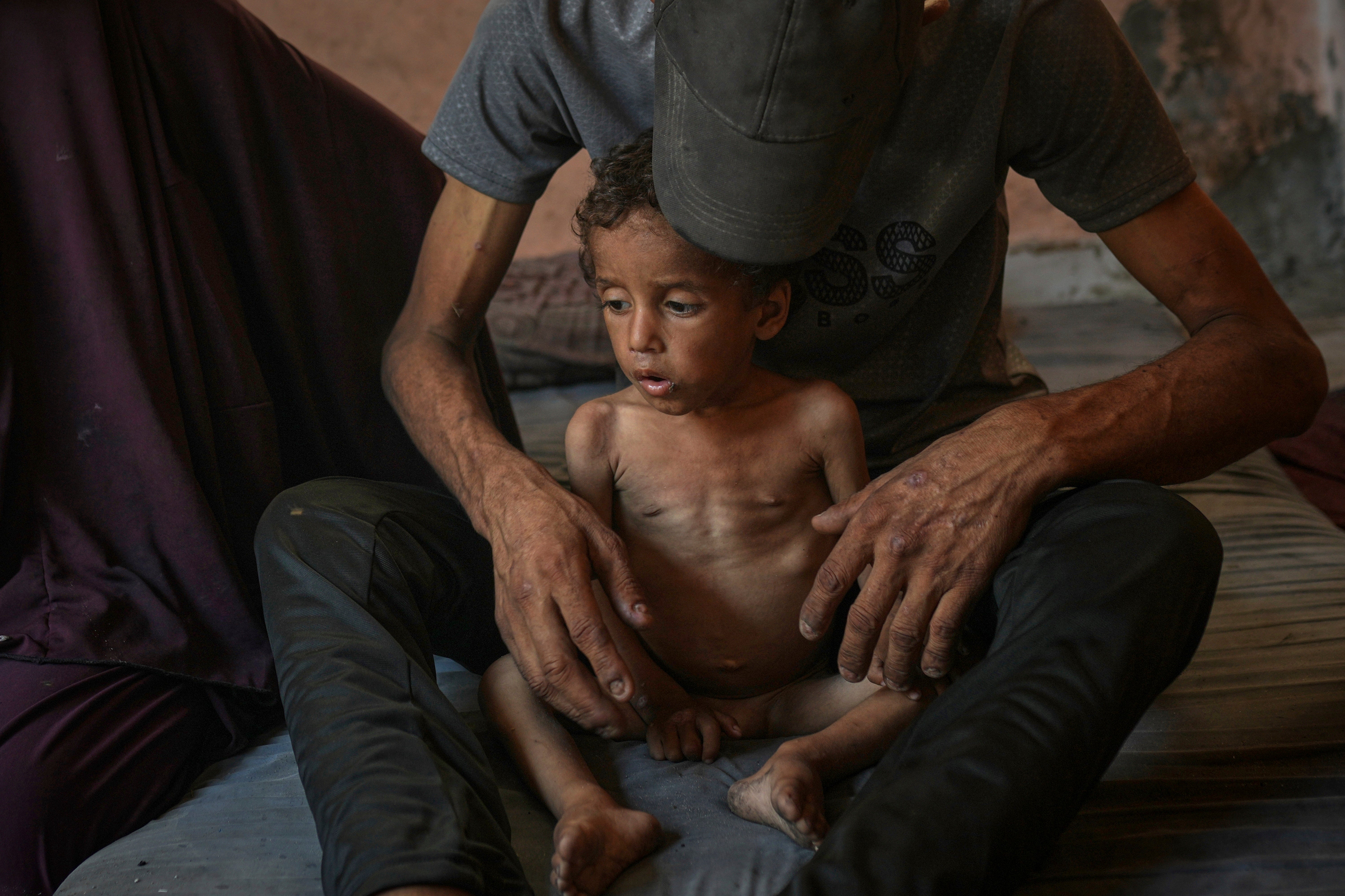 Yazan Abu Ful, a two-year-old malnourished child, sits with his father for a picture at their home in the Shati refugee camp in Gaza City