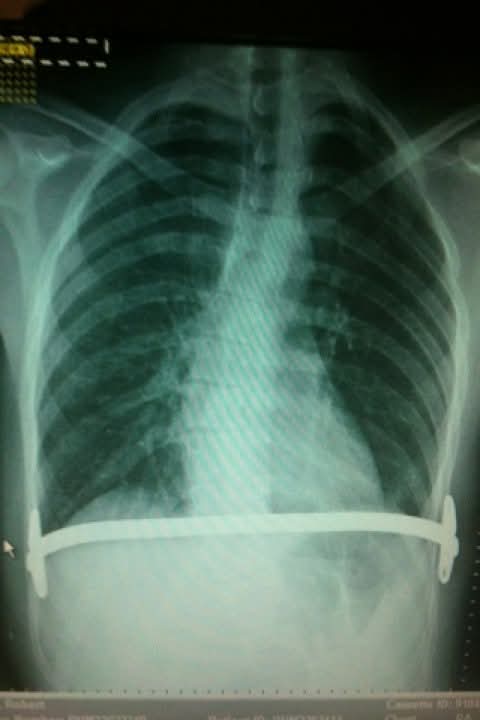 In severe cases pectus excavatum can require surgery where a bar is places inside the chest, pictured here on Mr Lindsell