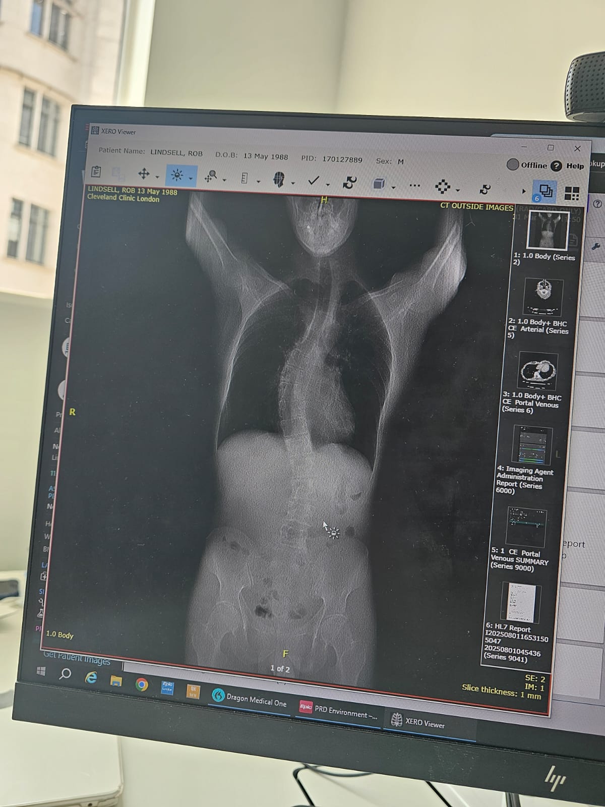 Rob Lindsell had an X-ray at a private clinic which revealed he not only has a hernia but his spine has deteriorated