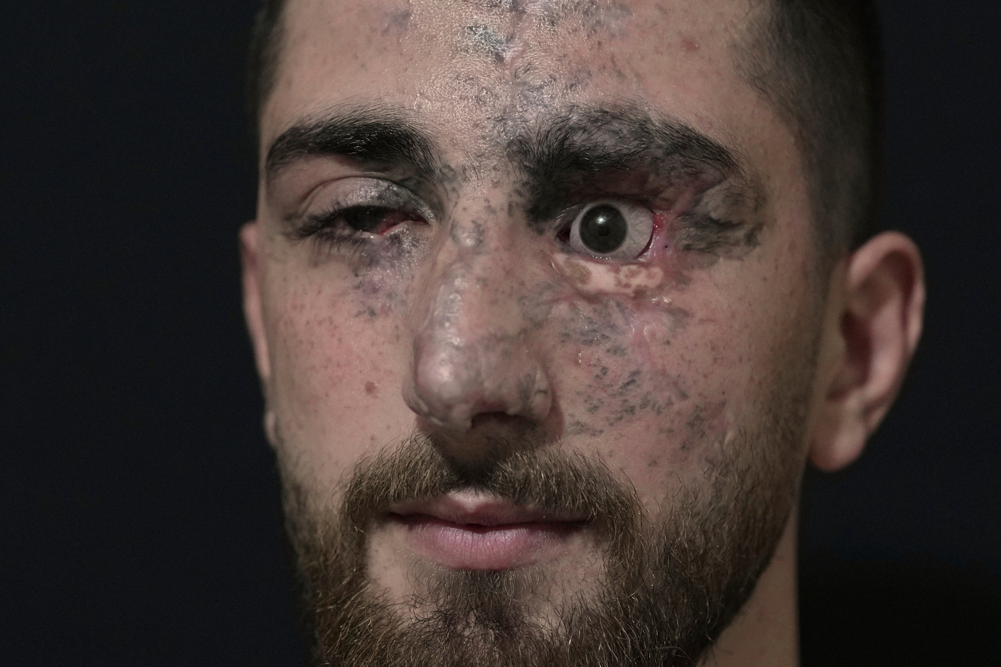 Lebanon Pager Attack Survivors Photo Essay