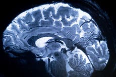 Breakthrough study finds deficiency of this common nutrient could contribute to Alzheimer’s