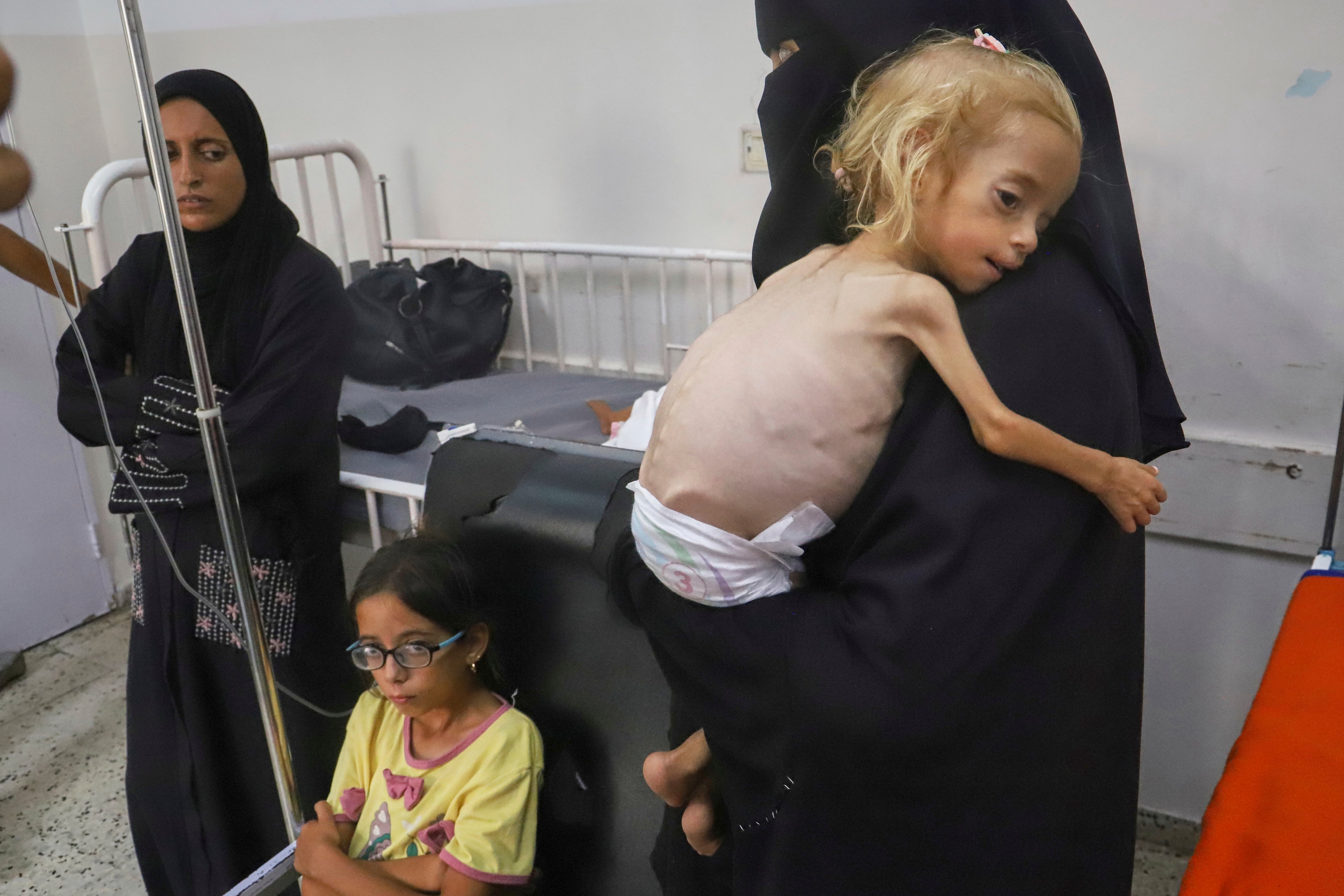 A severely malnourished two-year-old girl at Nasser Hospital in Khan Younis, southern Gaza