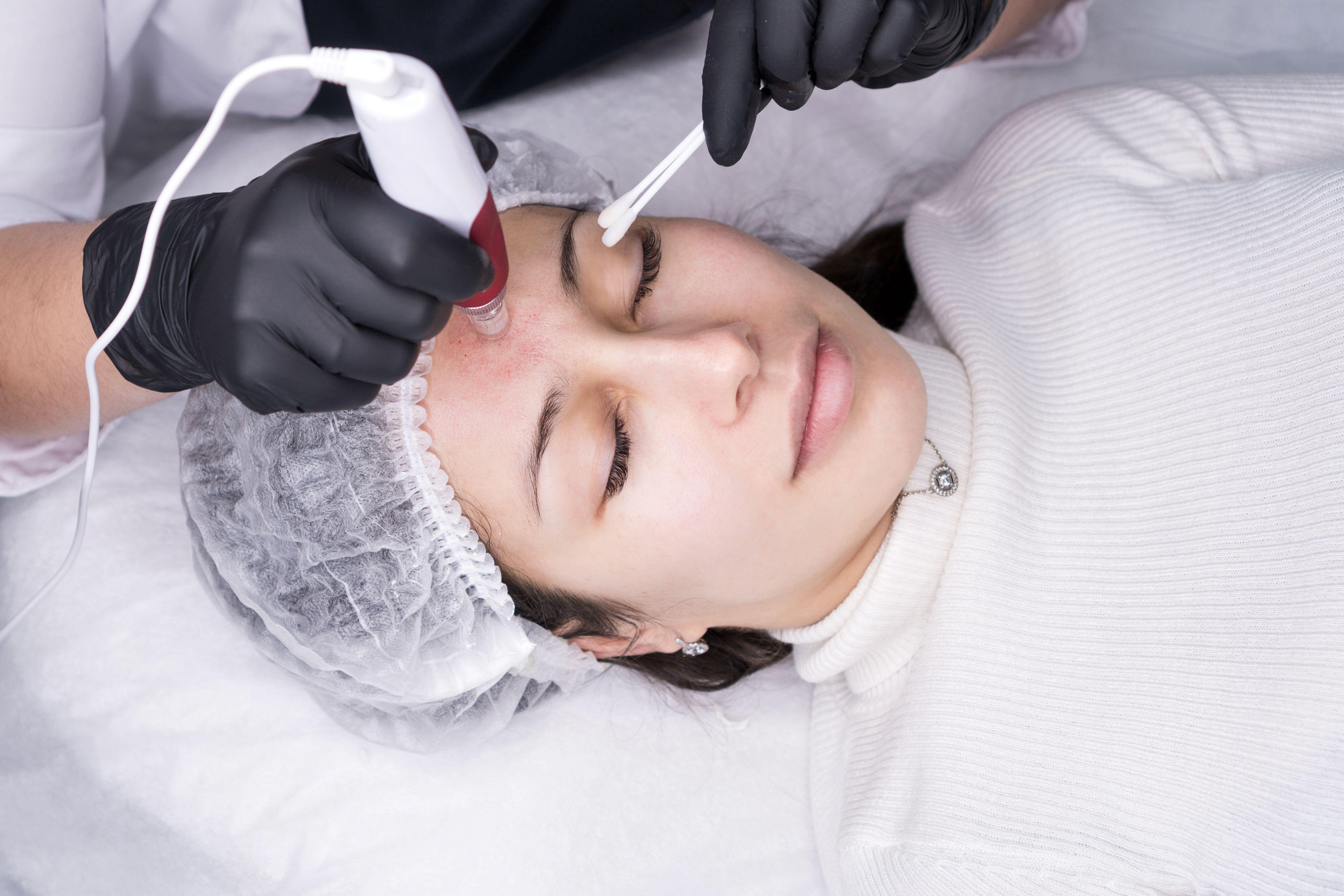 Micro needling can help combat fine lines and pigmentation