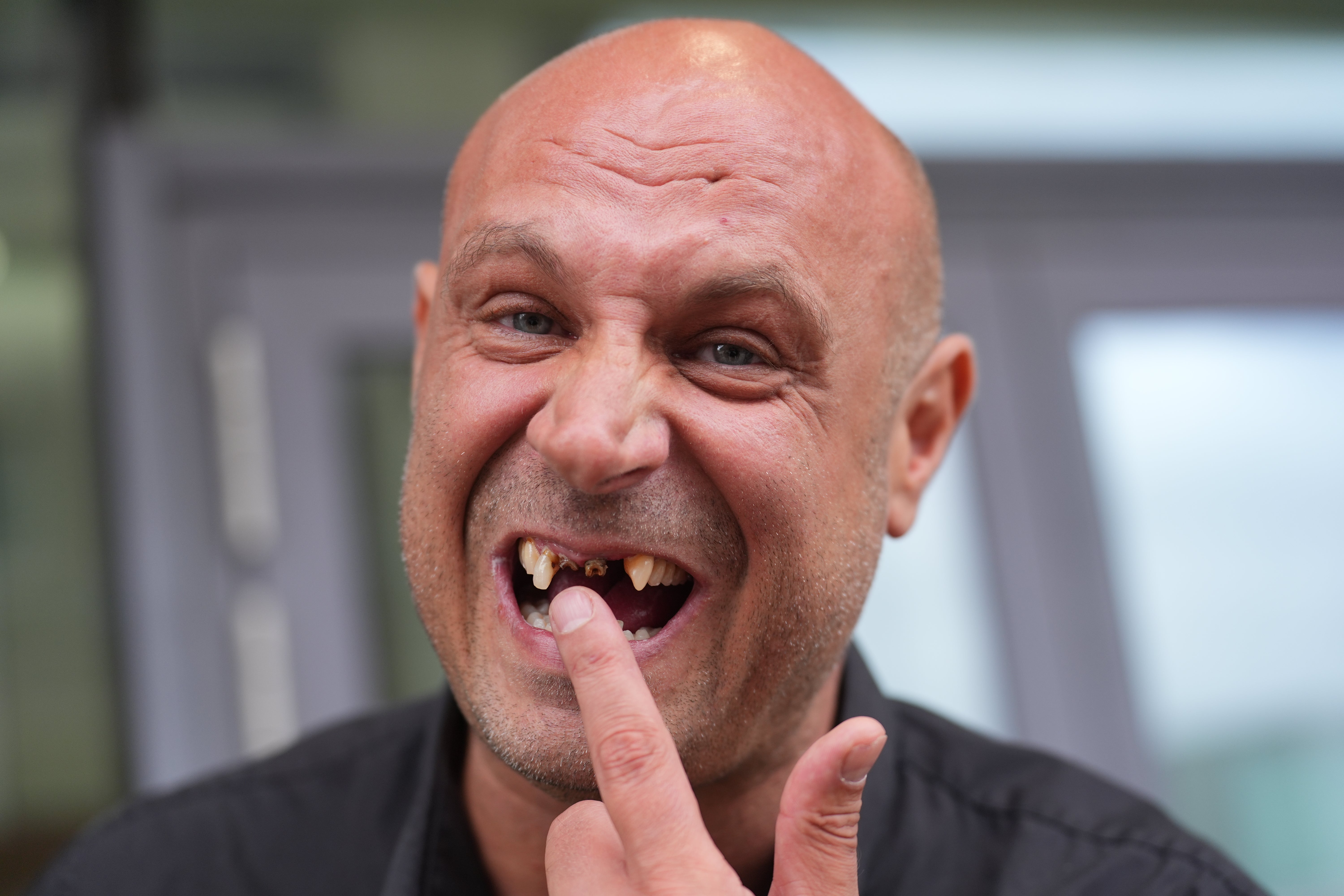 Jonathan Glover shows his missing crown teeth outside Chelmsford Crown Court
