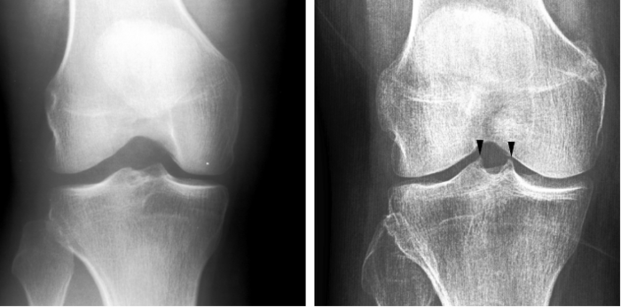 AI tries to detect sign of osteoarthritis