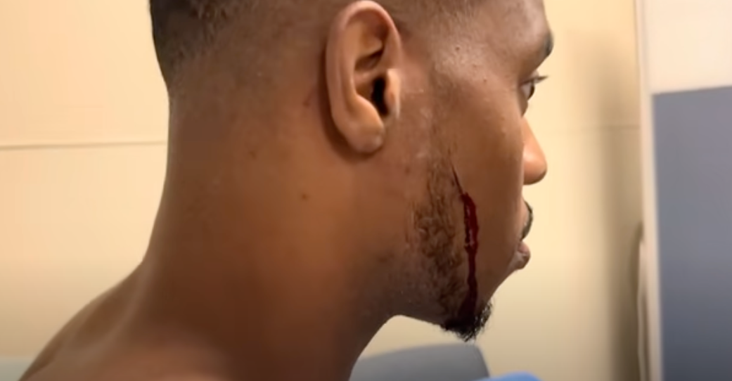 Patrick Blackwood managed to get a deep cut on the face from the crash