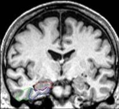 MRI brain depicts areas of interest in the brain's medial temporal lobe: hippocampus (outlined in red), entorhinal cortex (blue), and perirhinal cortex (green)