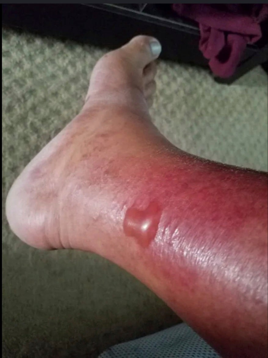 What at first appeared to be a sun blister led to three months in the hospital