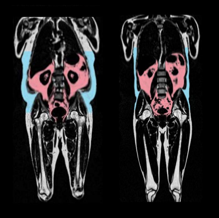 Two MRI scans showing a person’s visible fat in blue and deeper fat in red. Even people who weigh a healthy amount can have a large amount of the hidden fat