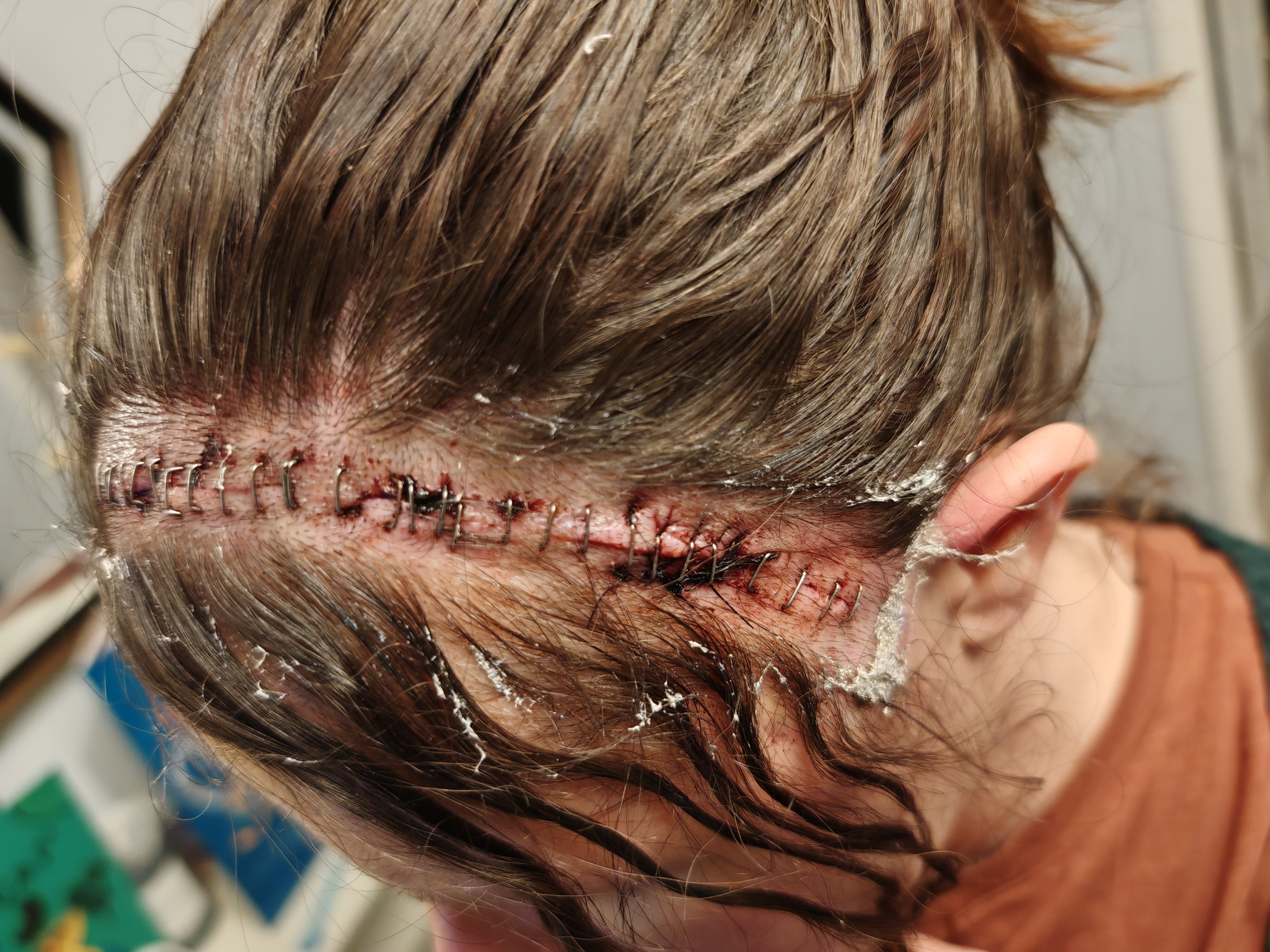 Nikita disse que os médicos foram capazes de remover o tumor na íntegra