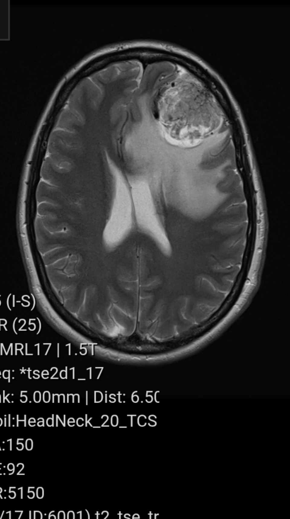 Nikita fez um teste de ressonância magnética, que revelou seu tumor