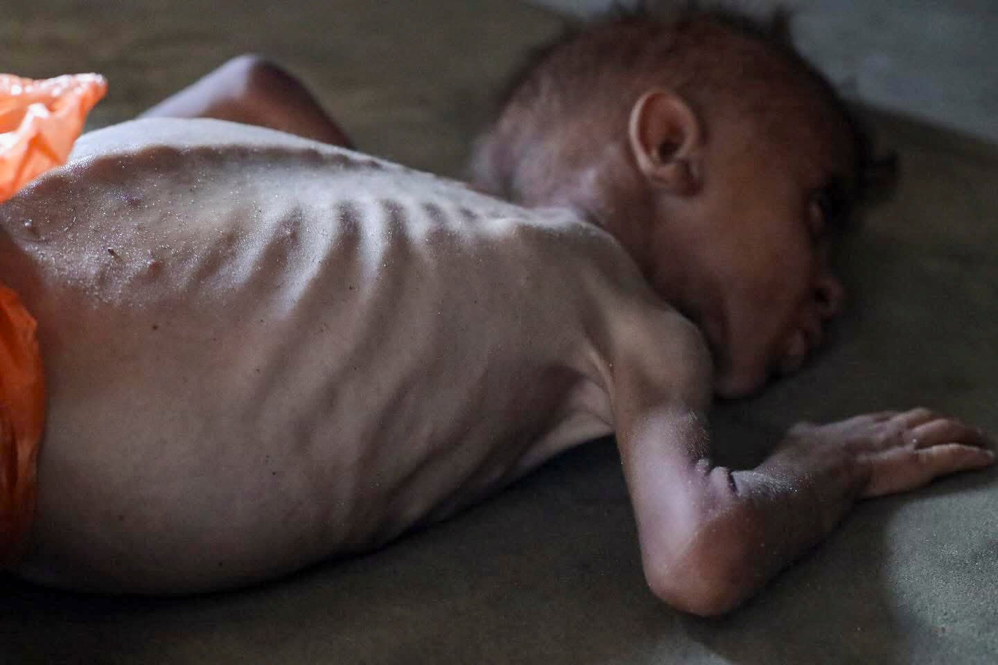 A severely malnourished Palestinian baby lies on a blanket inside a shelter in Gaza