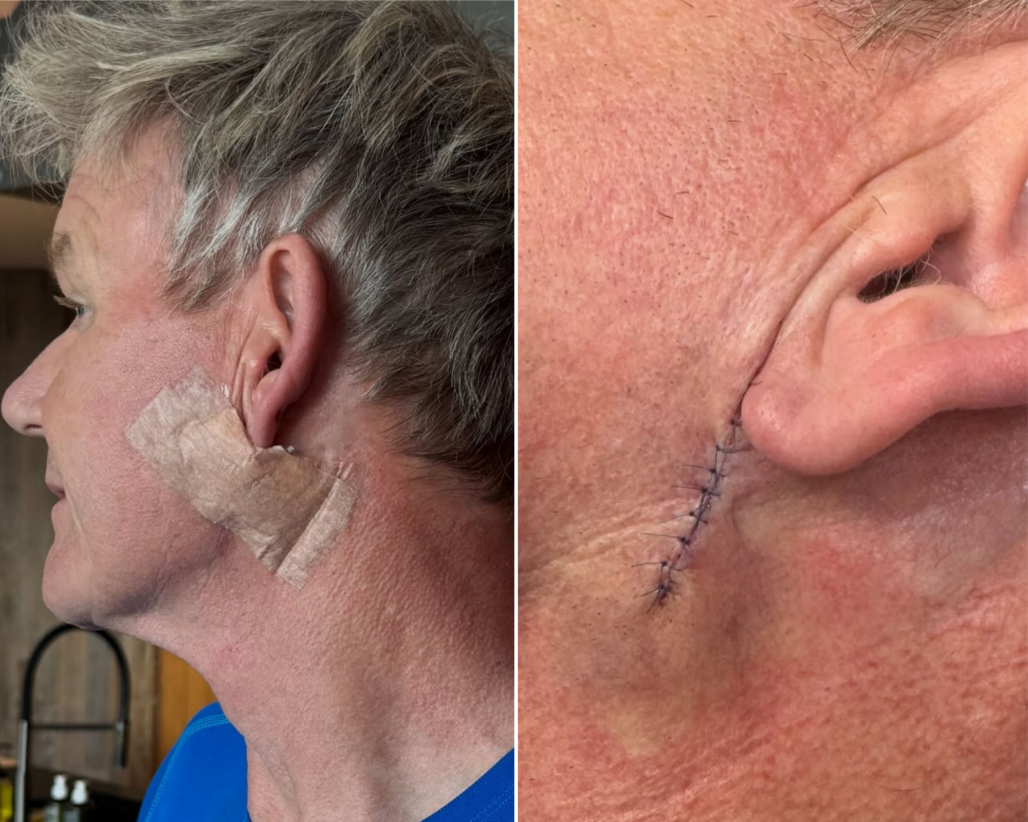 Gordon Ramsay has undergone surgery to remove basal cell carcinoma